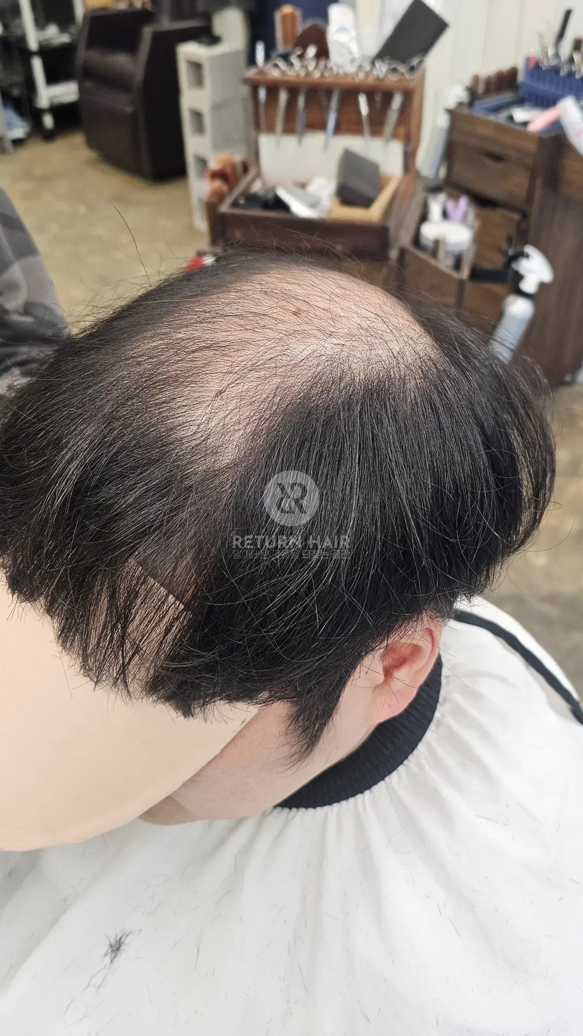 탈모 치트펌 파마 시술 전 사진 3
