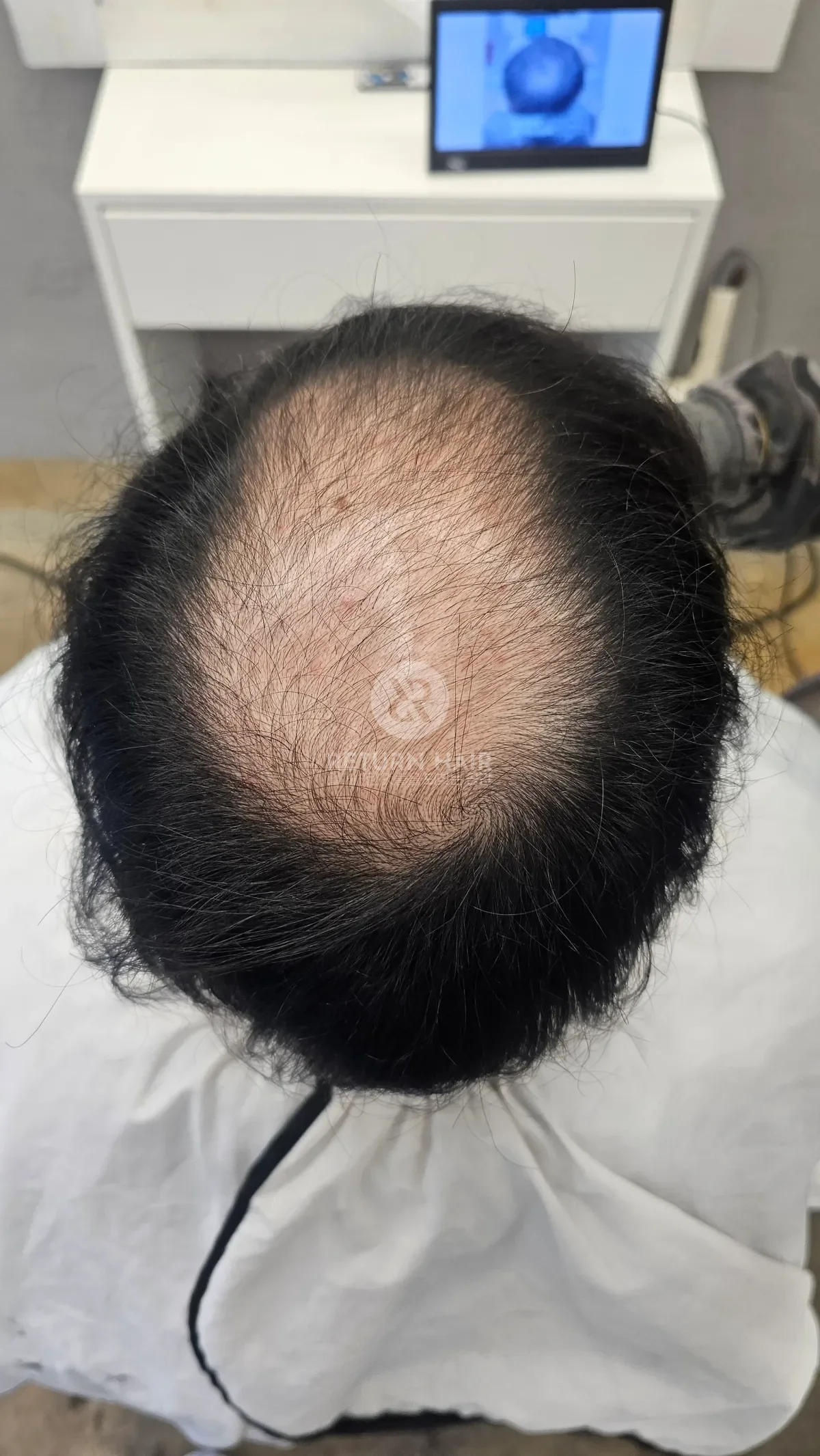 탈모 치트펌 파마 시술 전 사진 5