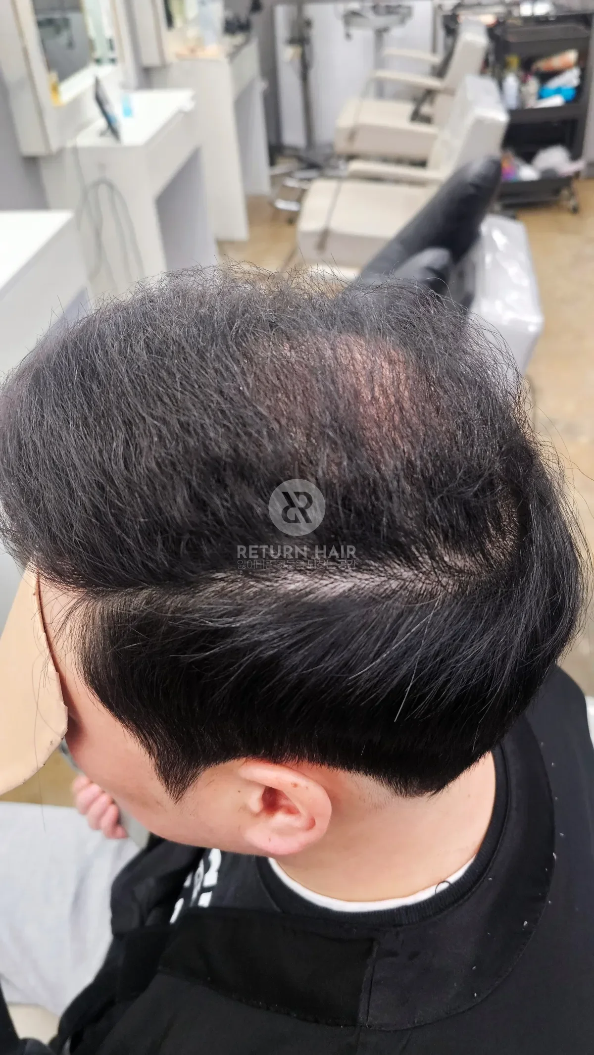 탈모 치트펌 파마 시술 후 결과 사진 4