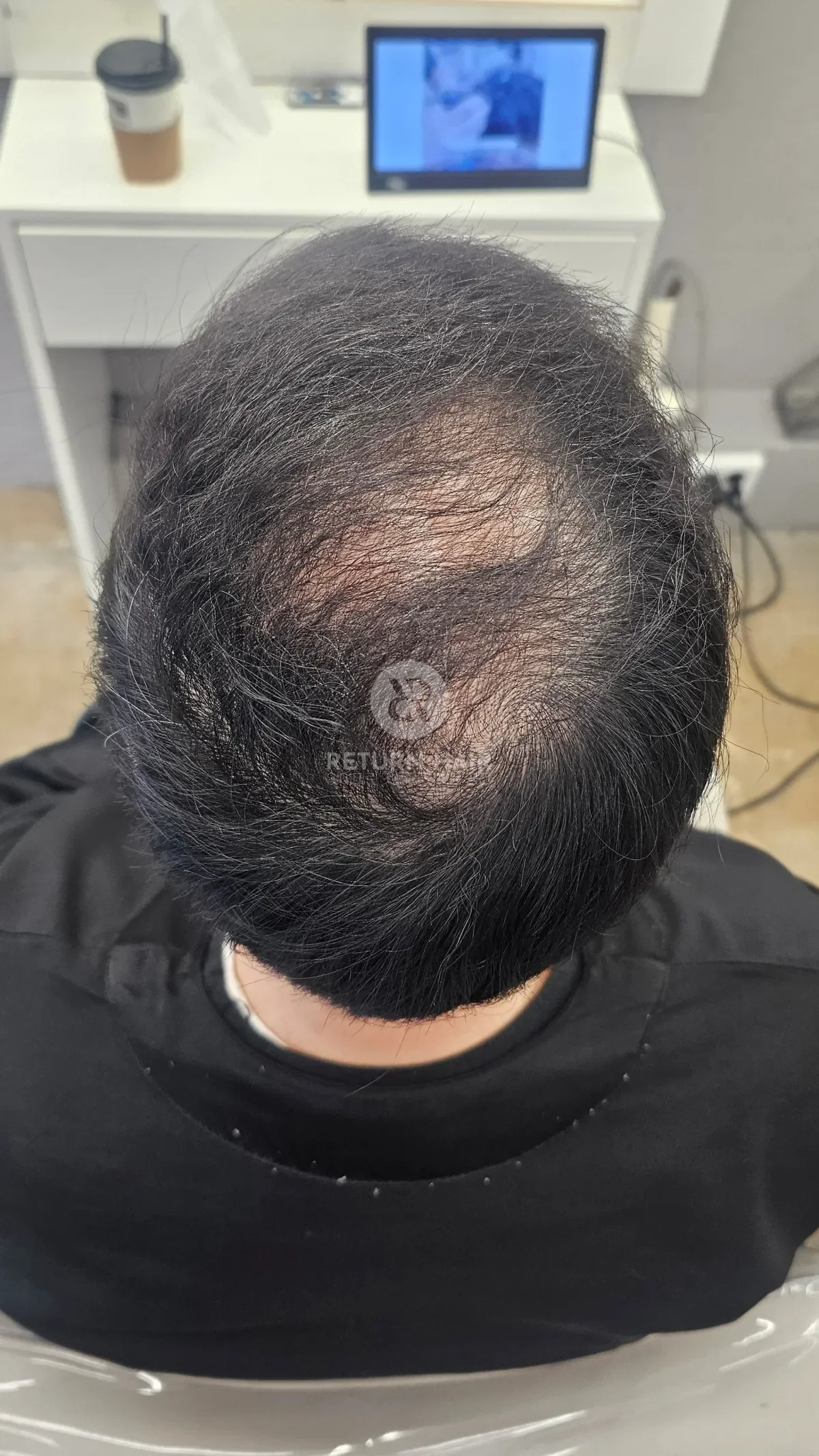 탈모 치트펌 파마 시술 후 결과 사진 5