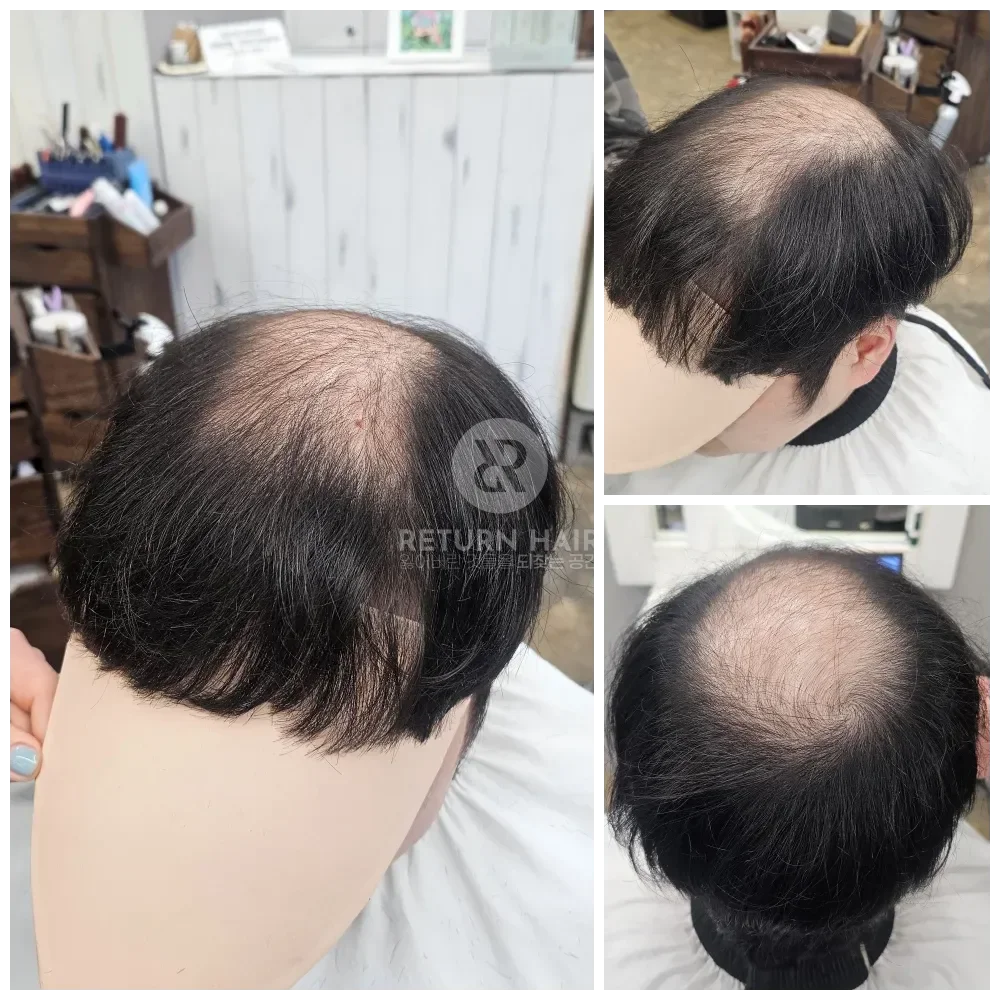 탈모 치트펌 파마 시술 전 사진