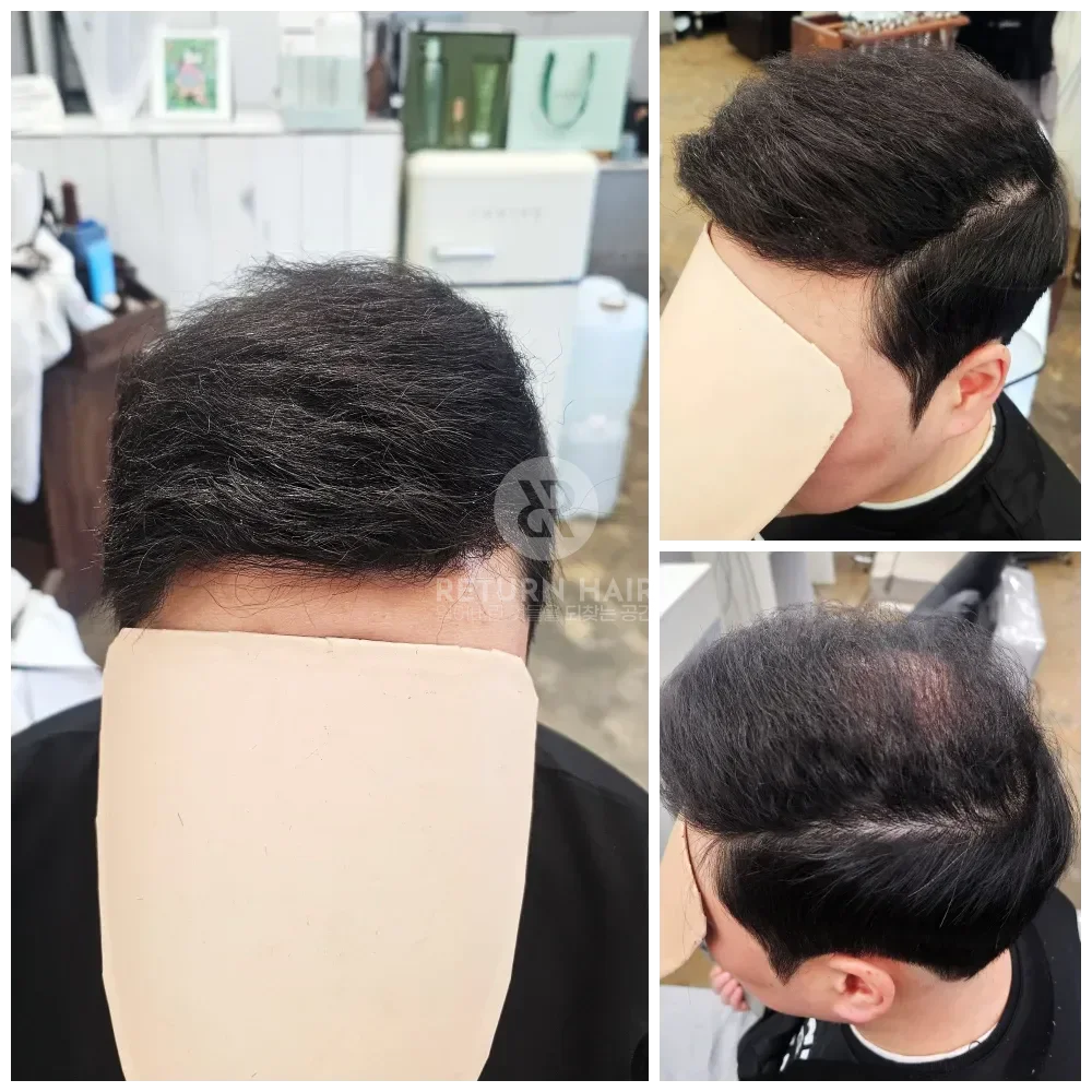 탈모 치트펌 파마 시술 후 결과 사진