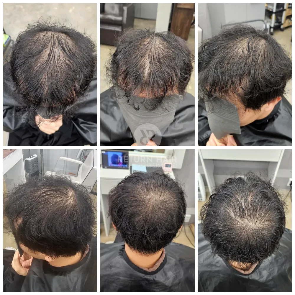 두피페인팅 (치트염색) 시술 전 사진