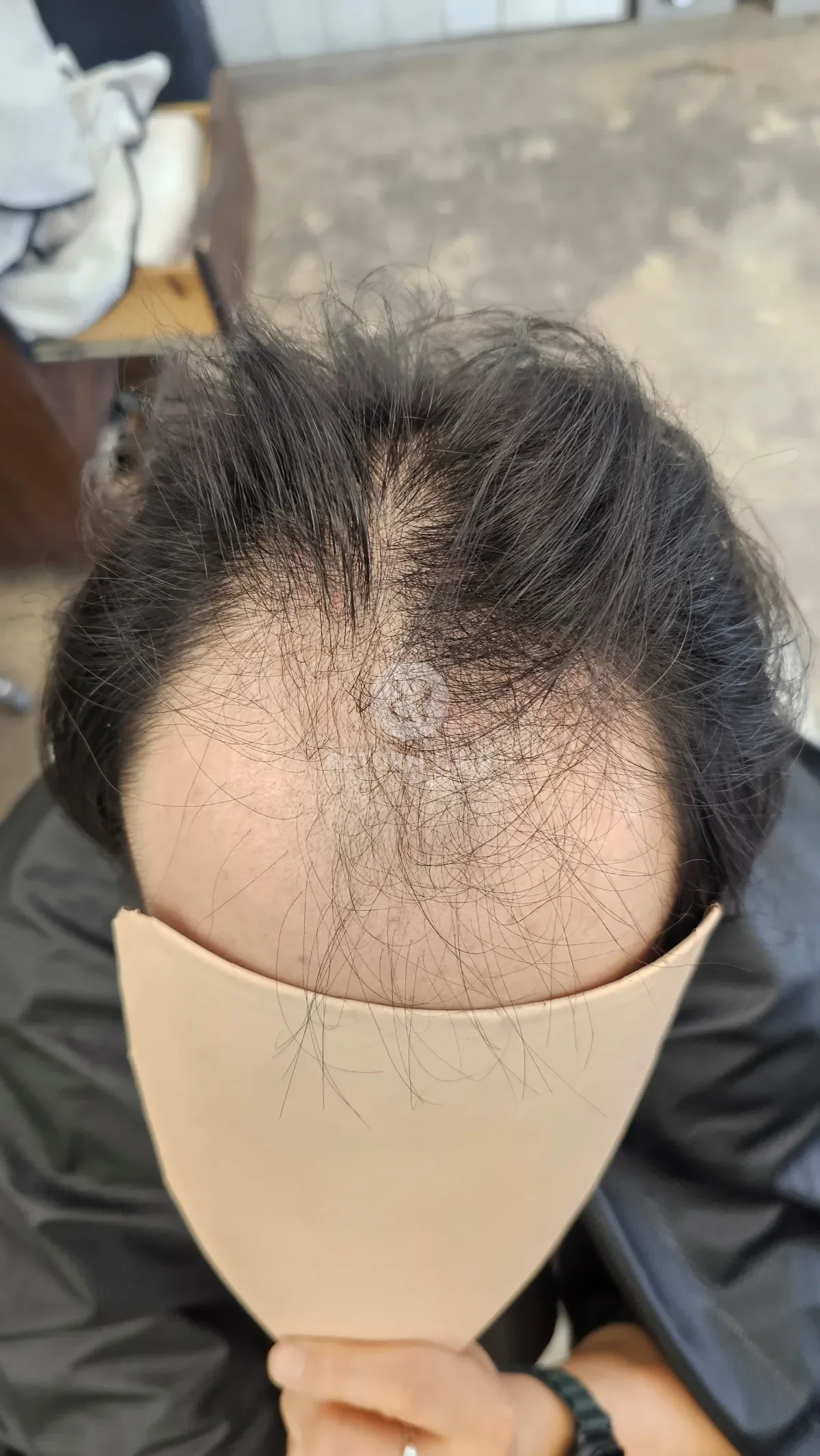탈모 치트펌 파마 시술 전 사진