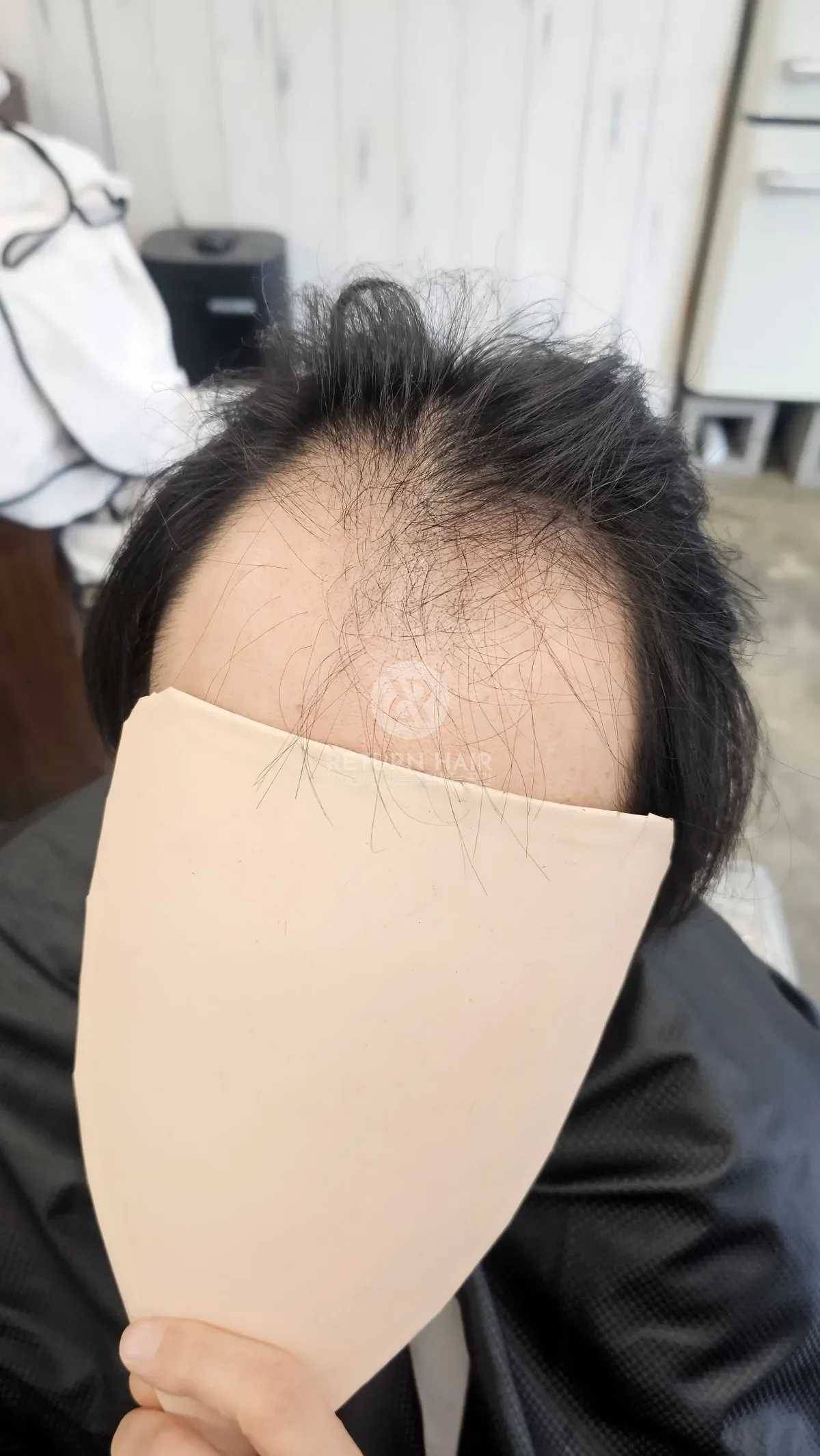 탈모 치트펌 파마 시술 전 사진 2