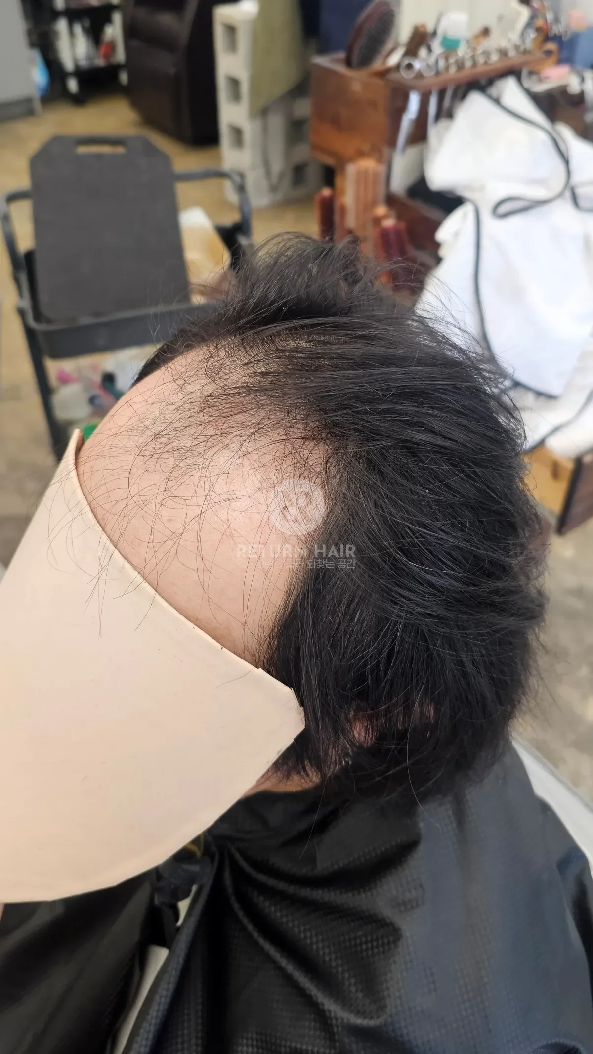 탈모 치트펌 파마 시술 전 사진 3