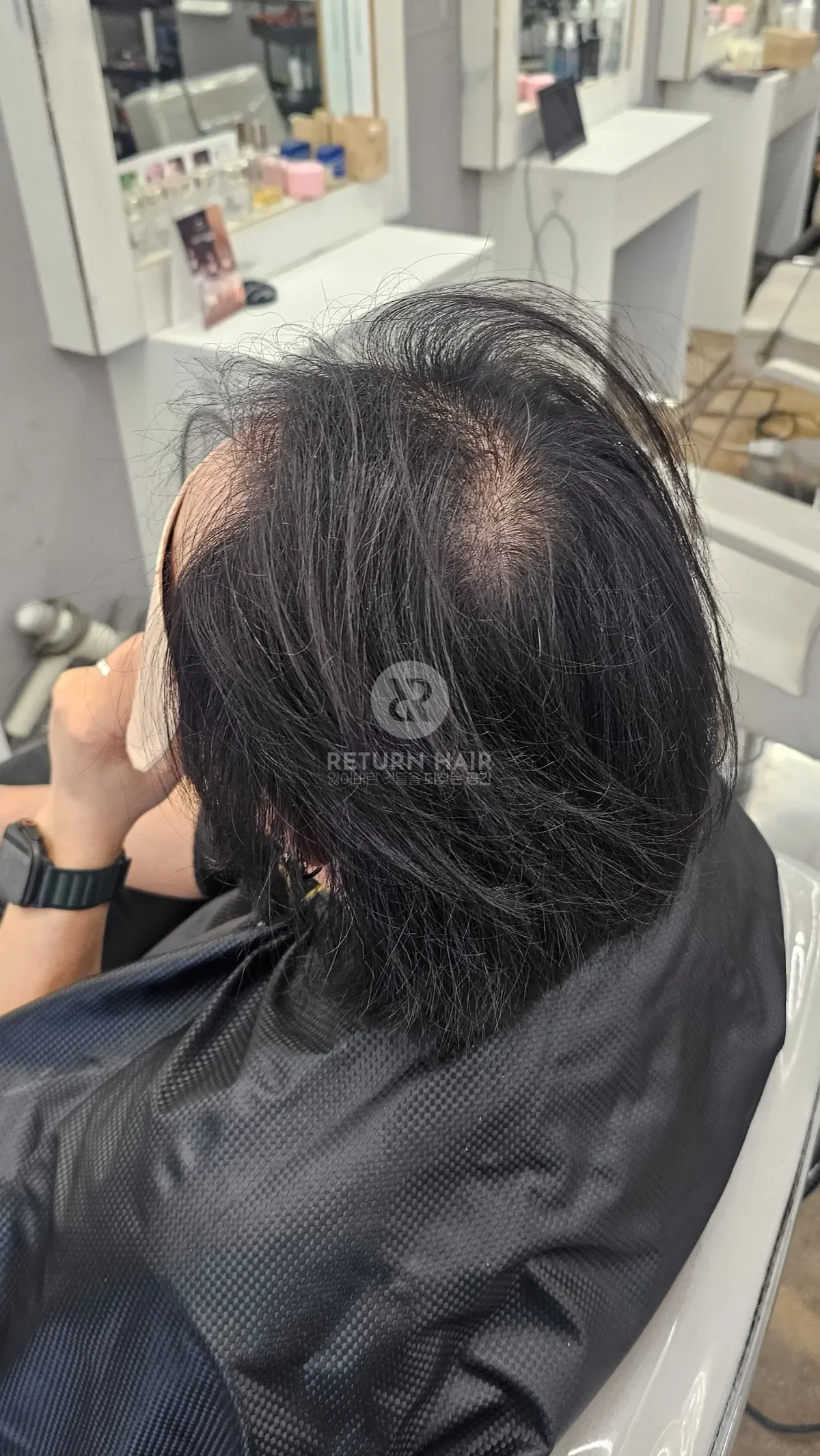 탈모 치트펌 파마 시술 전 사진 4