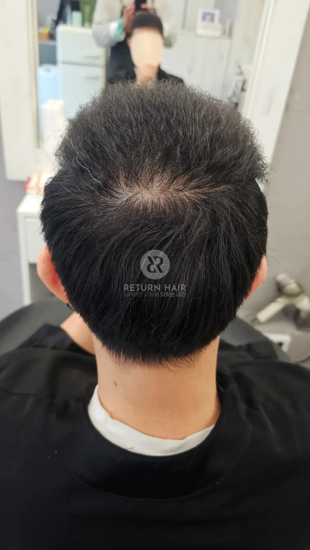 탈모 치트펌 파마 시술 후 결과 사진 6