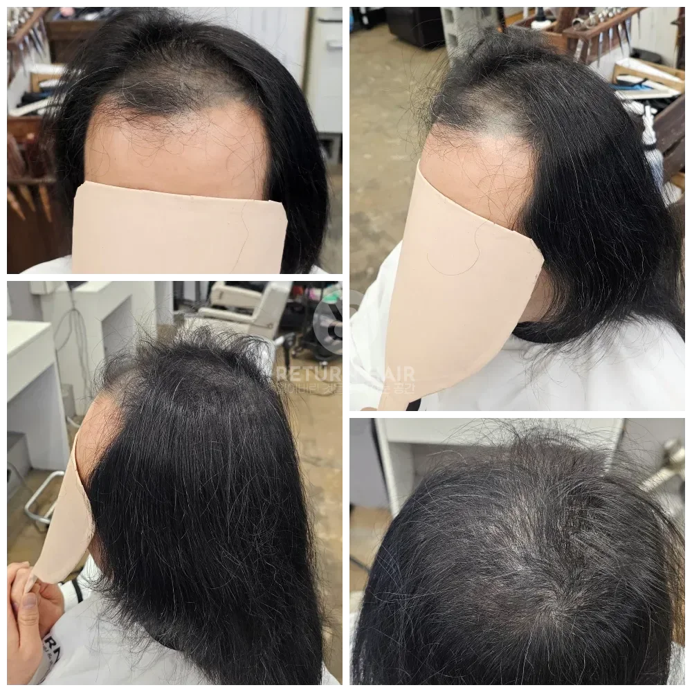 탈모 치트펌 파마 시술 전 사진