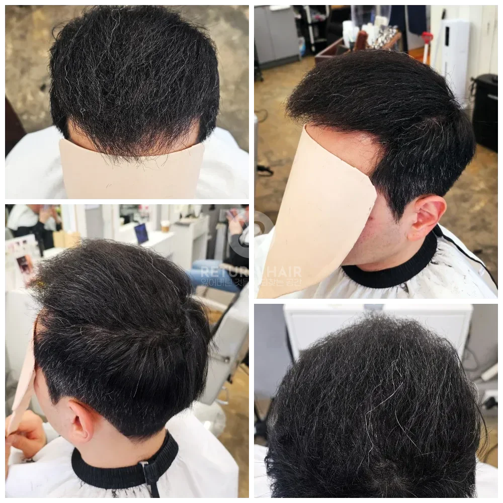 탈모 치트펌 파마 시술 후 결과 사진