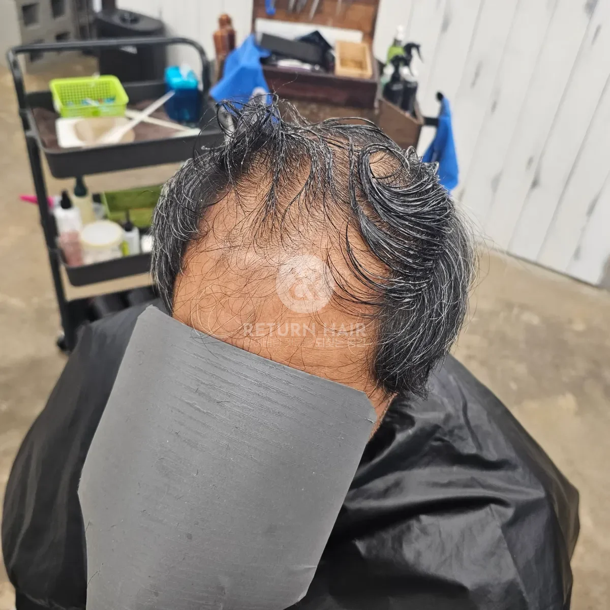 탈모 치트펌 파마 시술 전 사진
