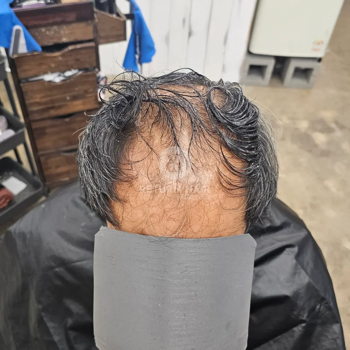 탈모 치트펌 파마 시술 전 사진 2