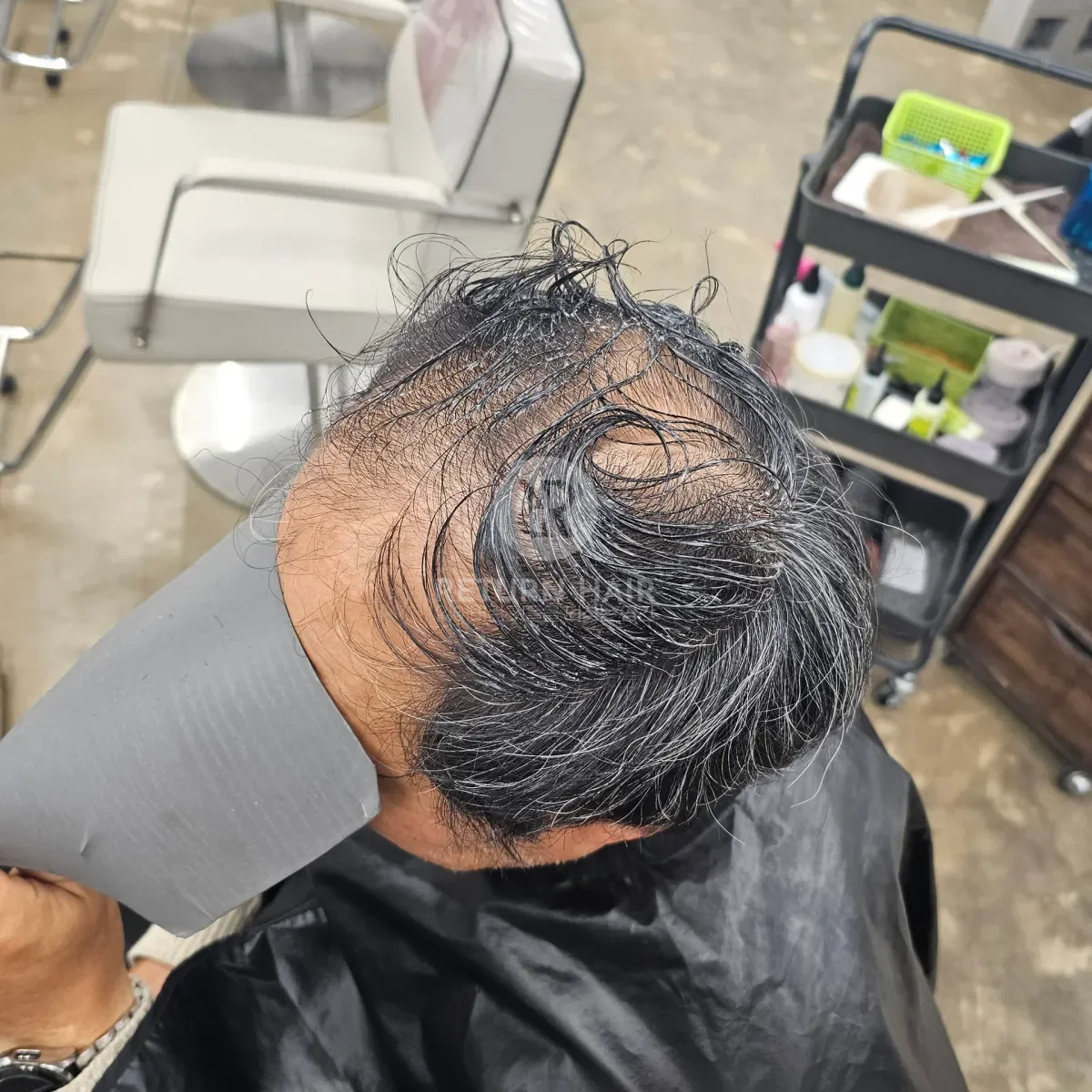 탈모 치트펌 파마 시술 전 사진 3