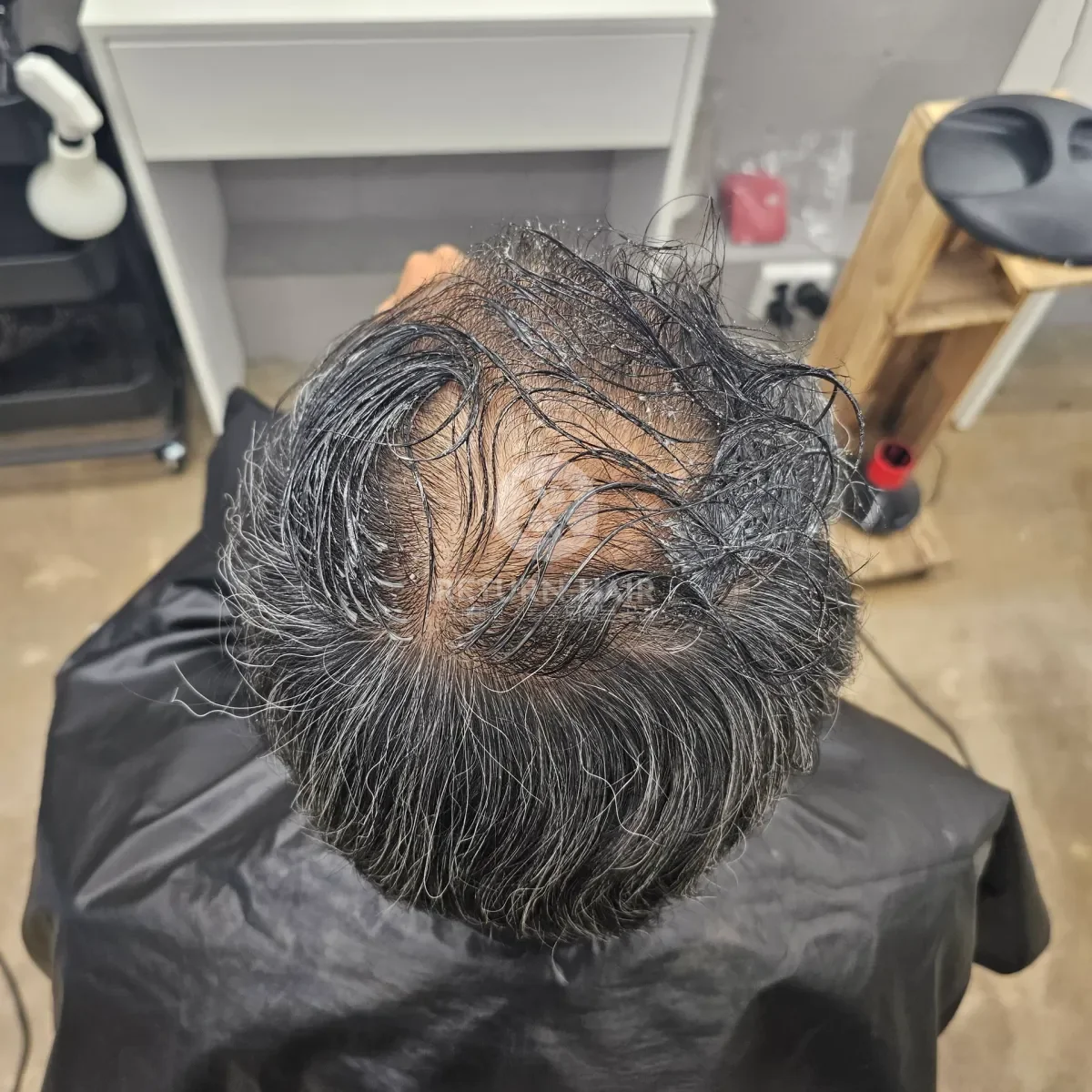 탈모 치트펌 파마 시술 전 사진 4