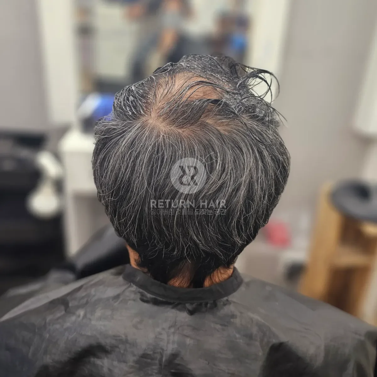 탈모 치트펌 파마 시술 전 사진 5