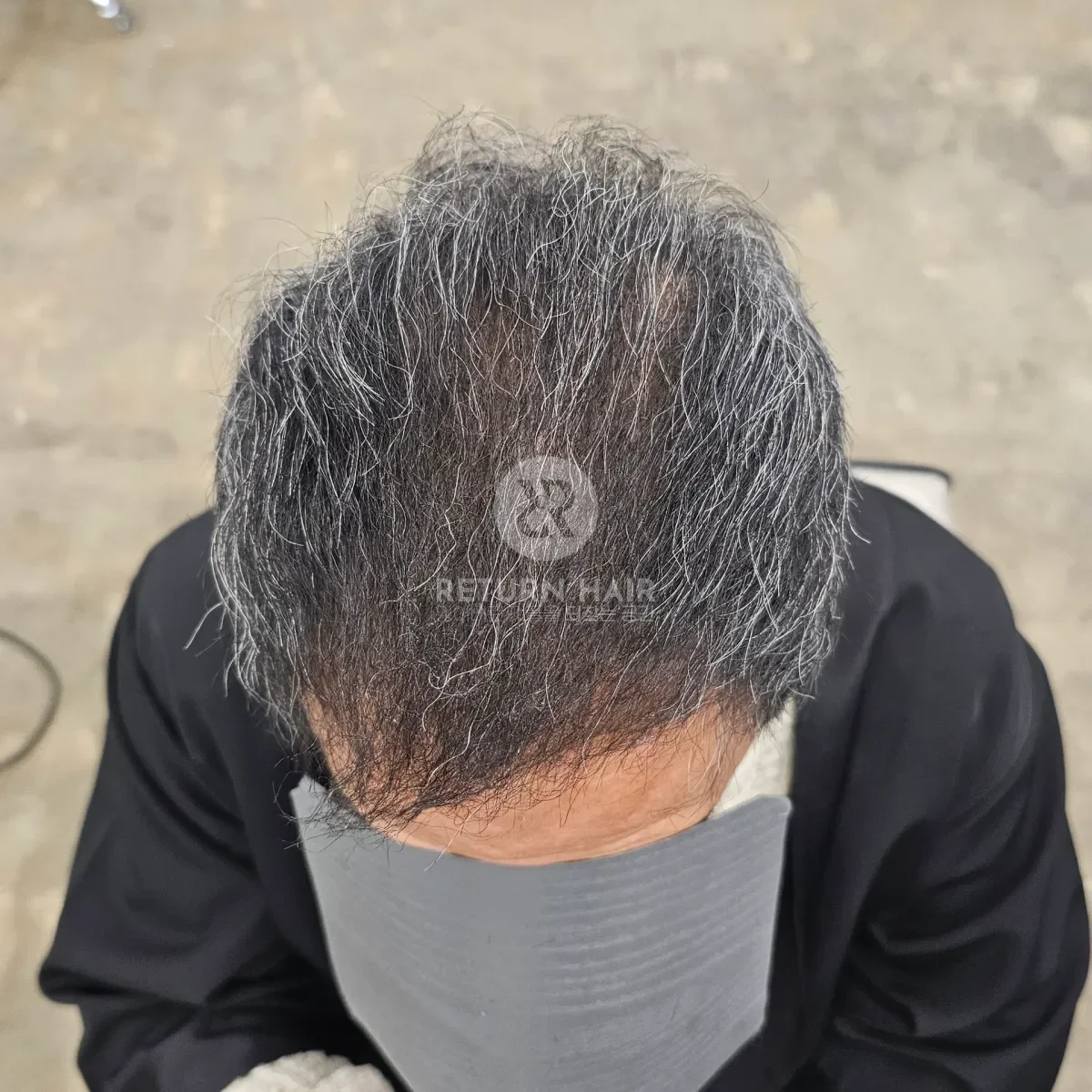 탈모 치트펌 파마 시술 후 결과 사진