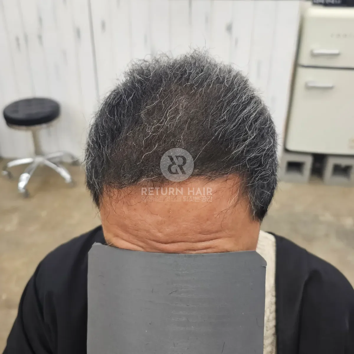 탈모 치트펌 파마 시술 후 결과 사진 2