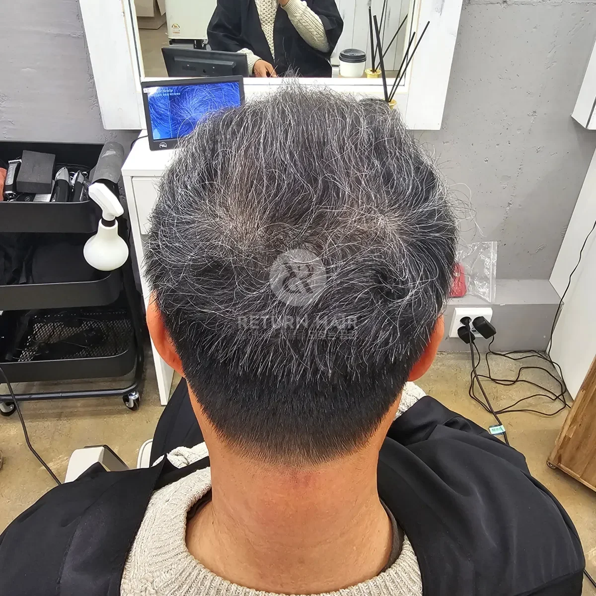 탈모 치트펌 파마 시술 후 결과 사진 6