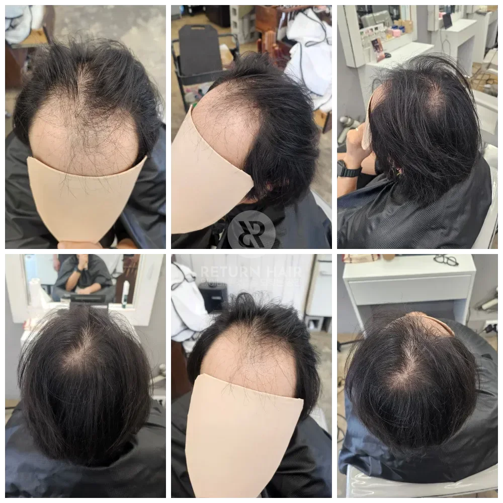 탈모 치트펌 파마 시술 전 사진