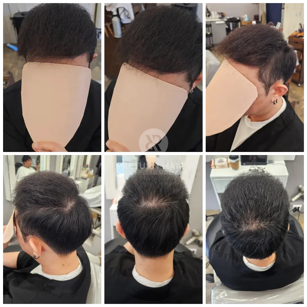 탈모 치트펌 파마 시술 후 결과 사진