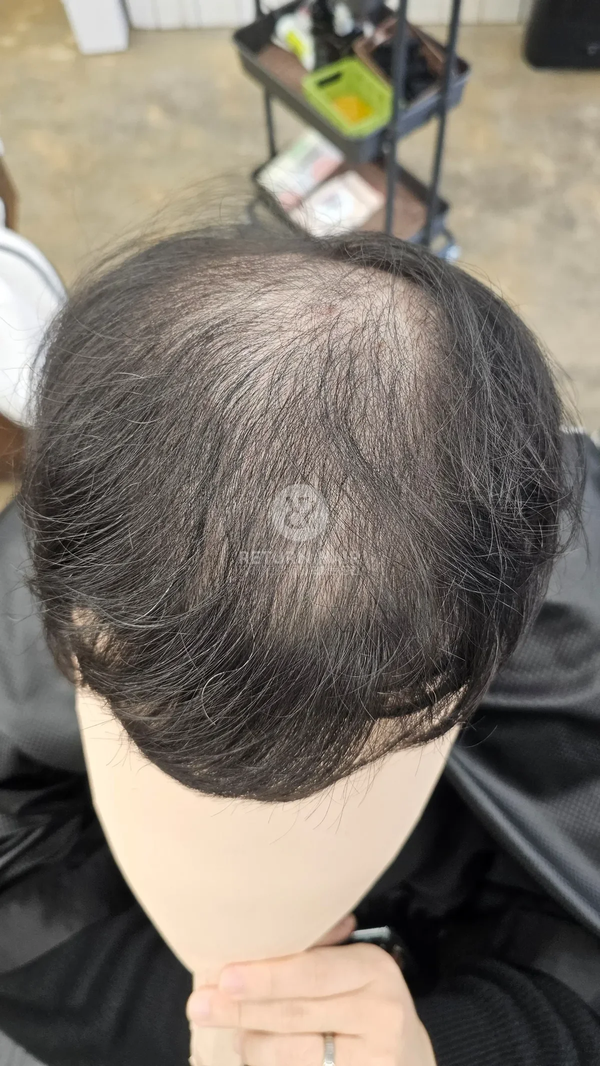 탈모 치트펌 파마 시술 전 사진