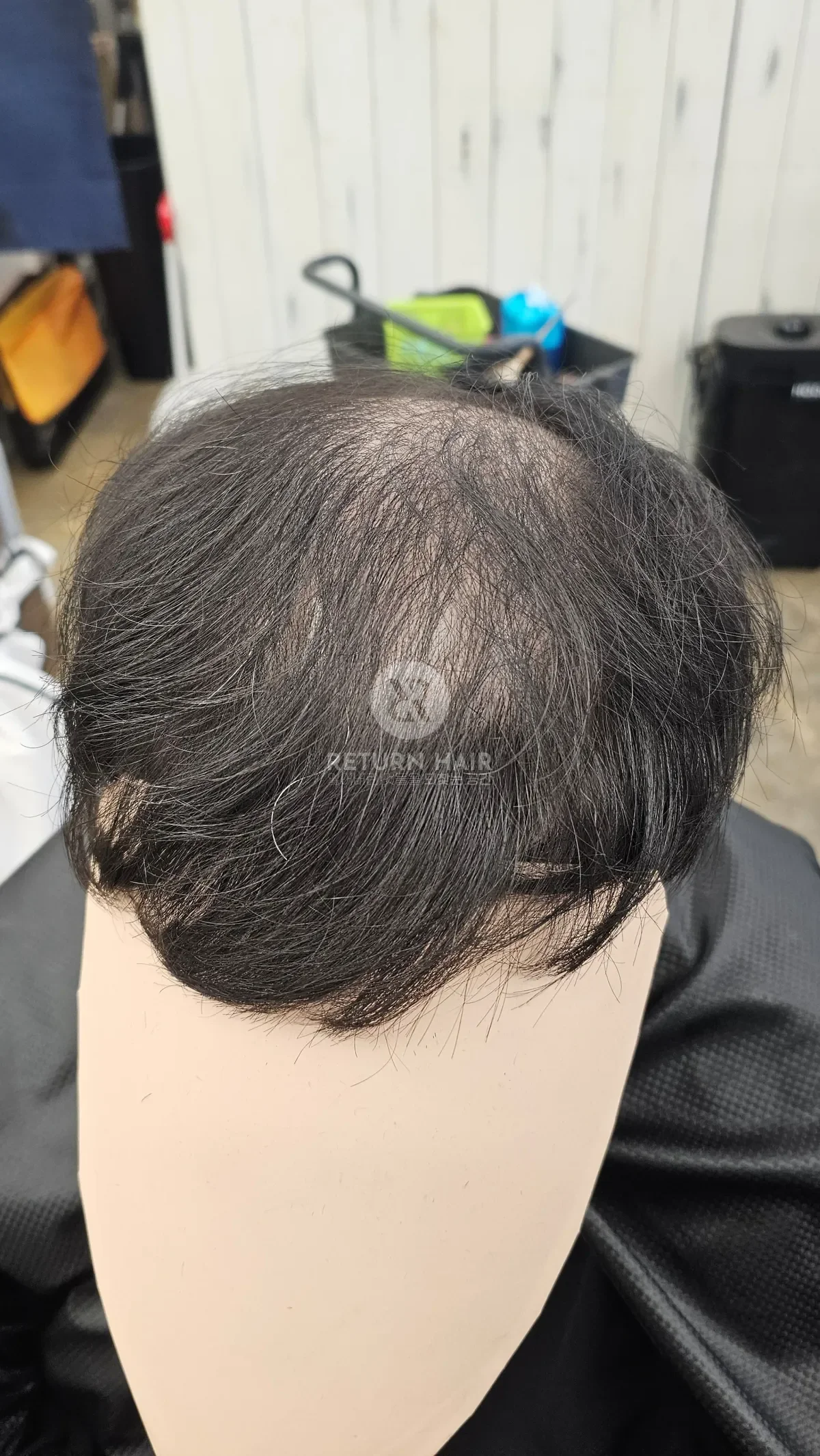 탈모 치트펌 파마 시술 전 사진 2
