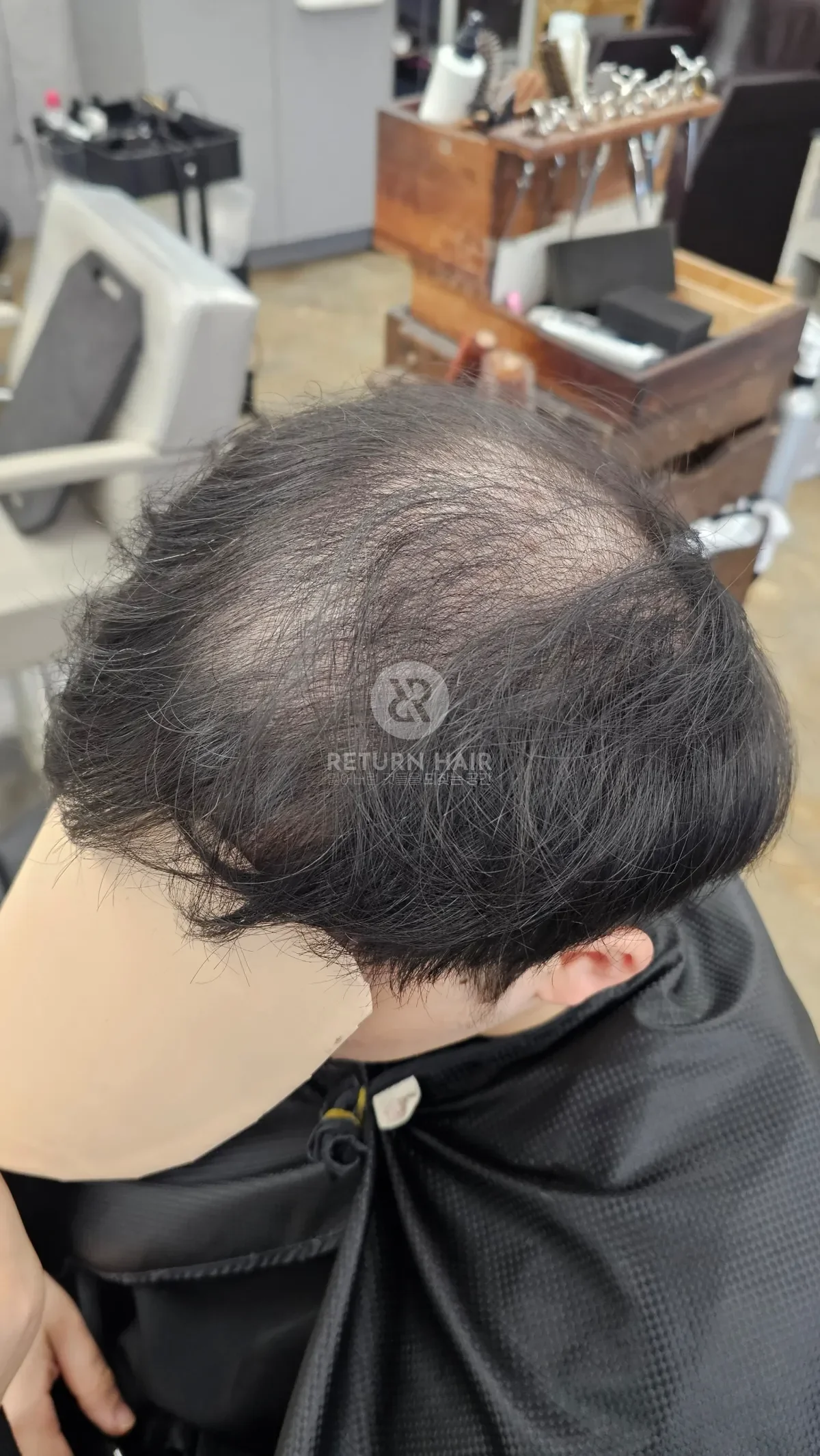 탈모 치트펌 파마 시술 전 사진 3