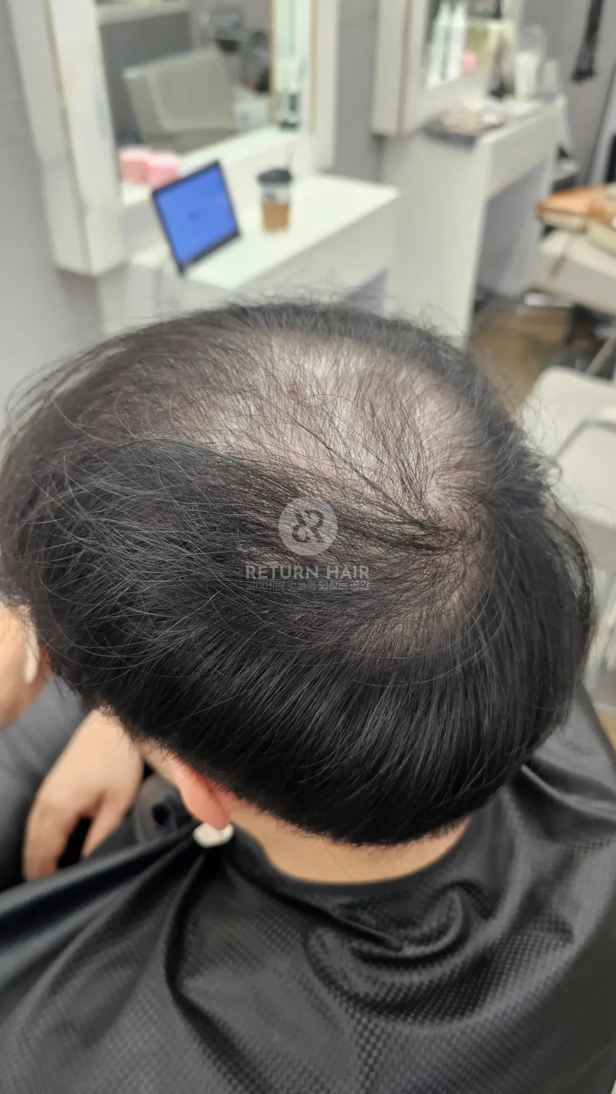 탈모 치트펌 파마 시술 전 사진 4