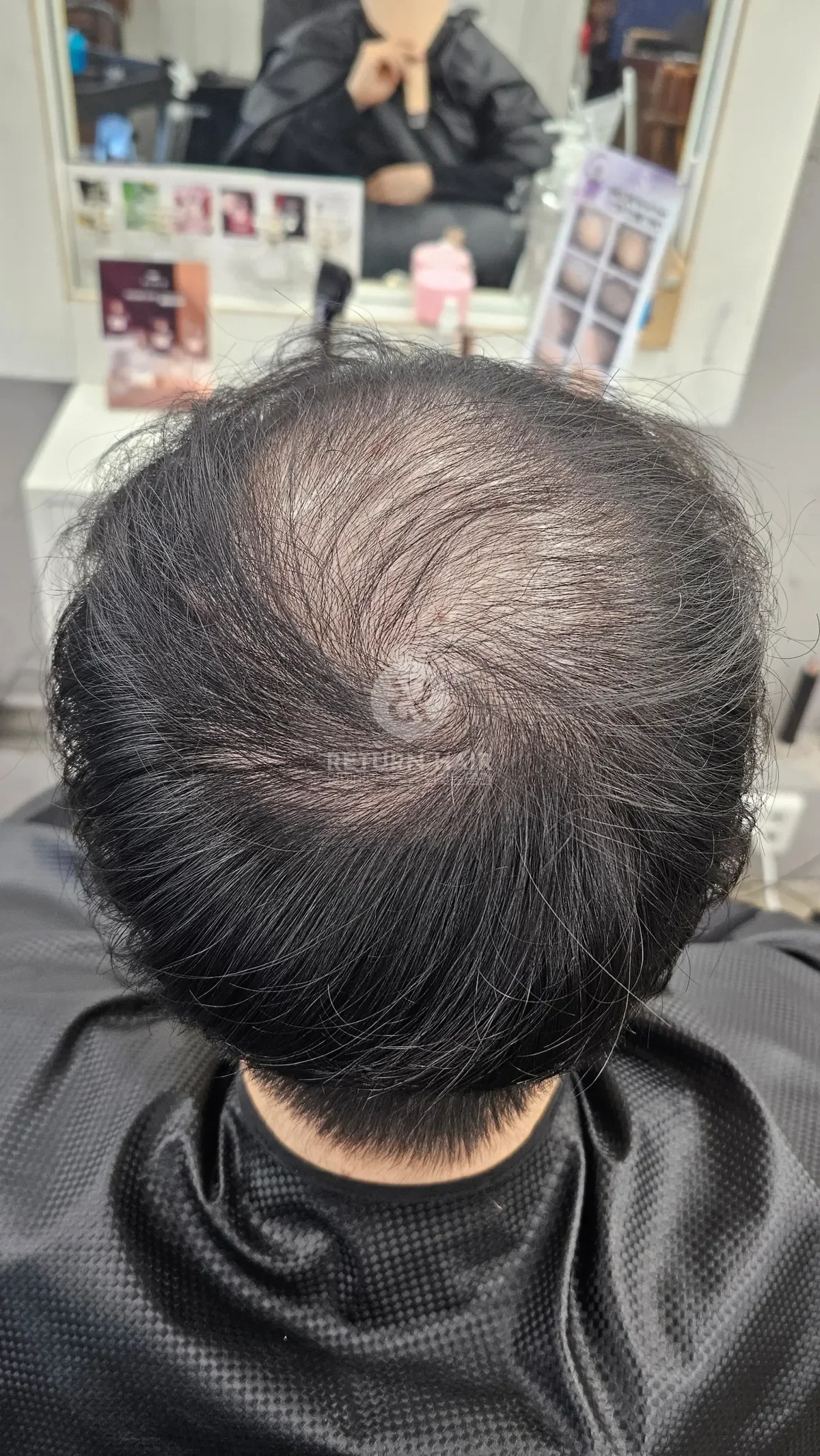 탈모 치트펌 파마 시술 전 사진 5