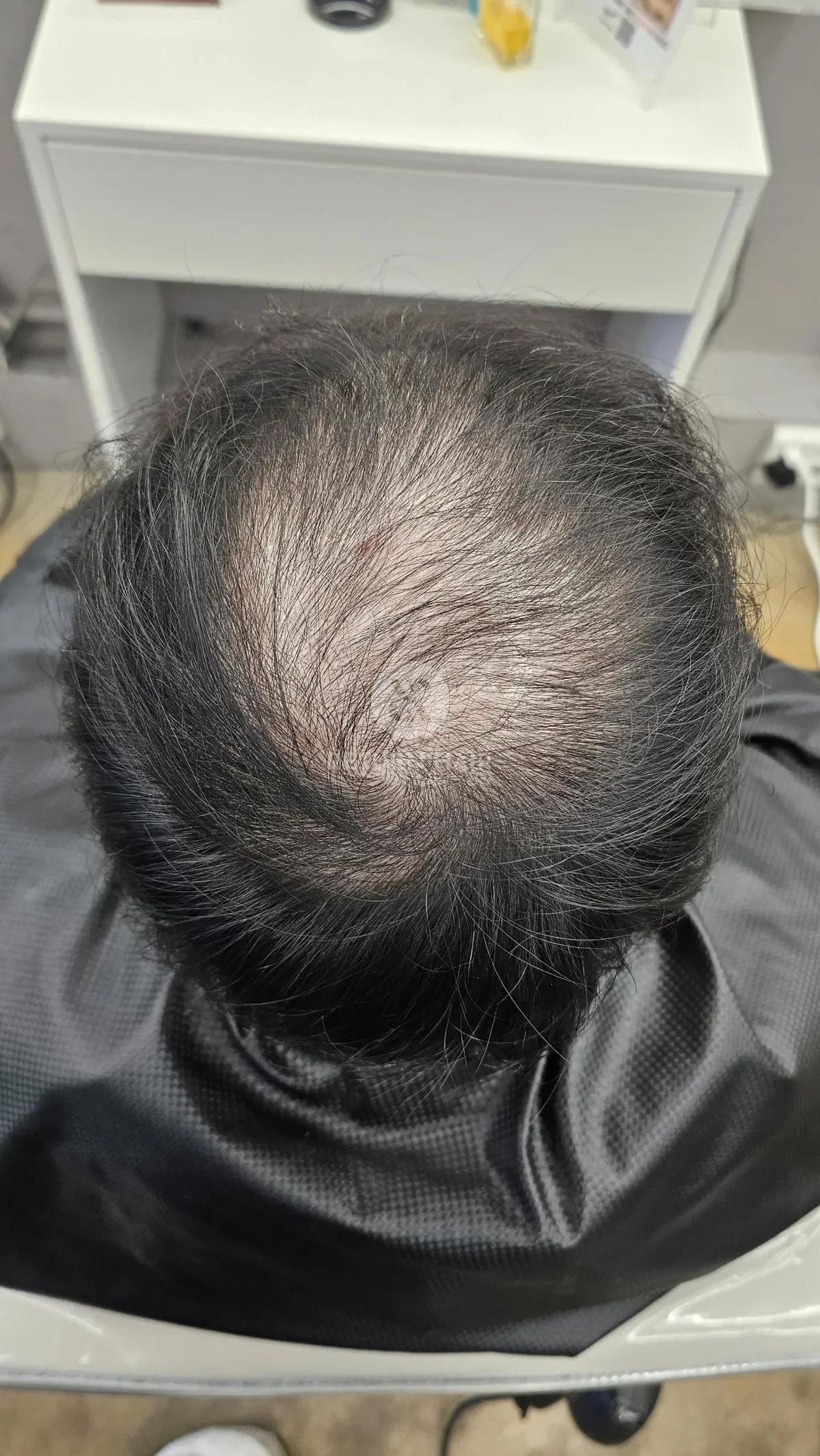 탈모 치트펌 파마 시술 전 사진 6