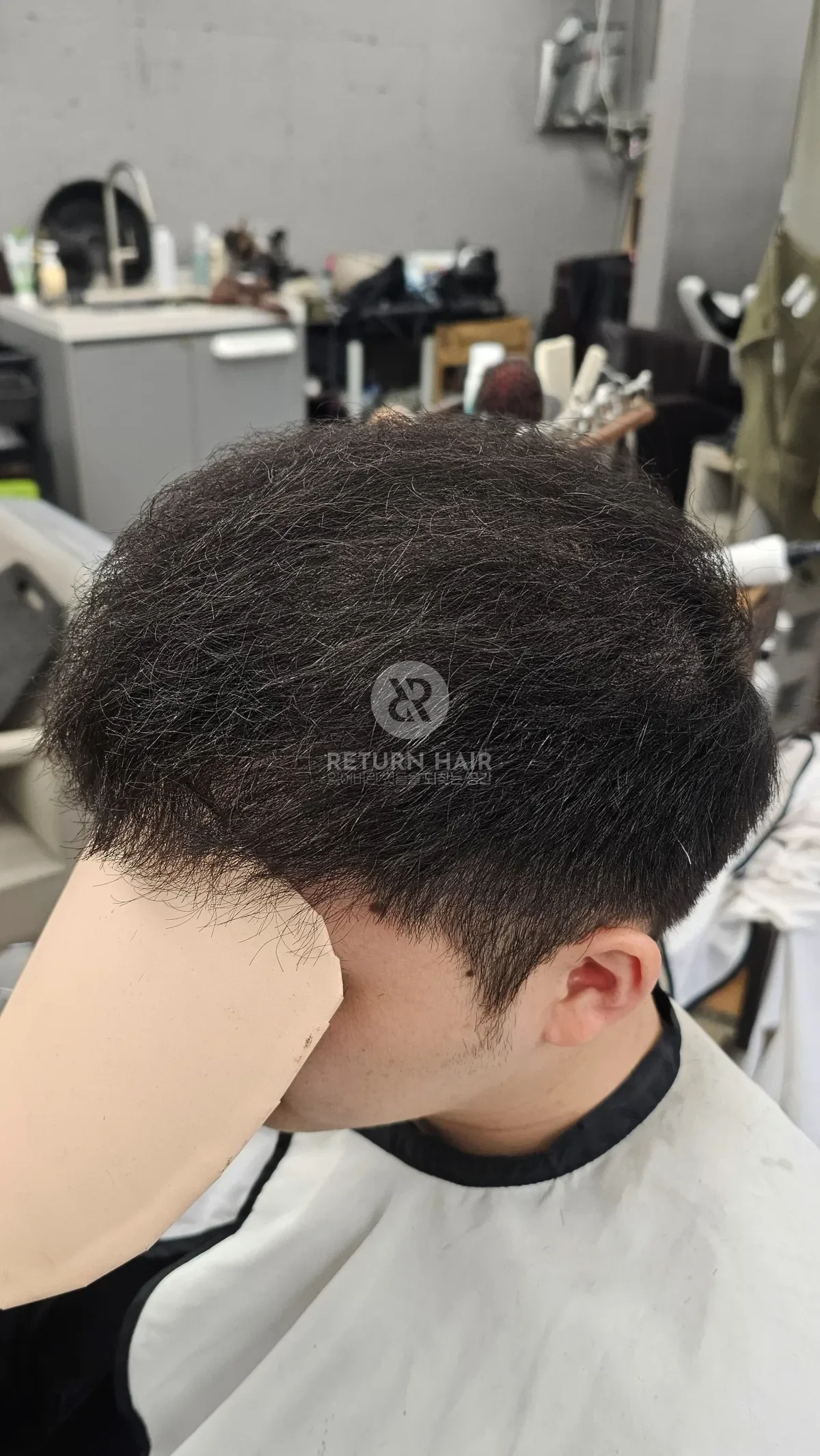 탈모 치트펌 파마 시술 후 결과 사진 3