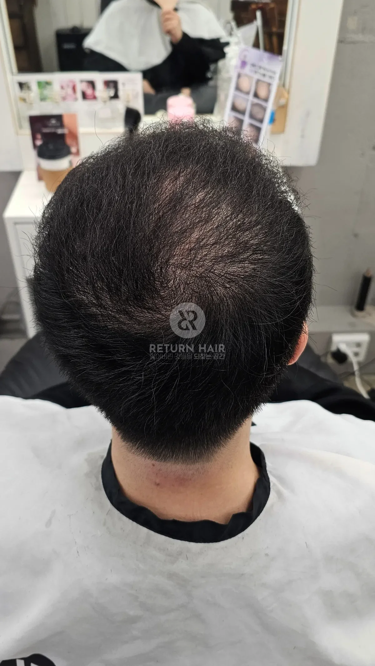 탈모 치트펌 파마 시술 후 결과 사진 5