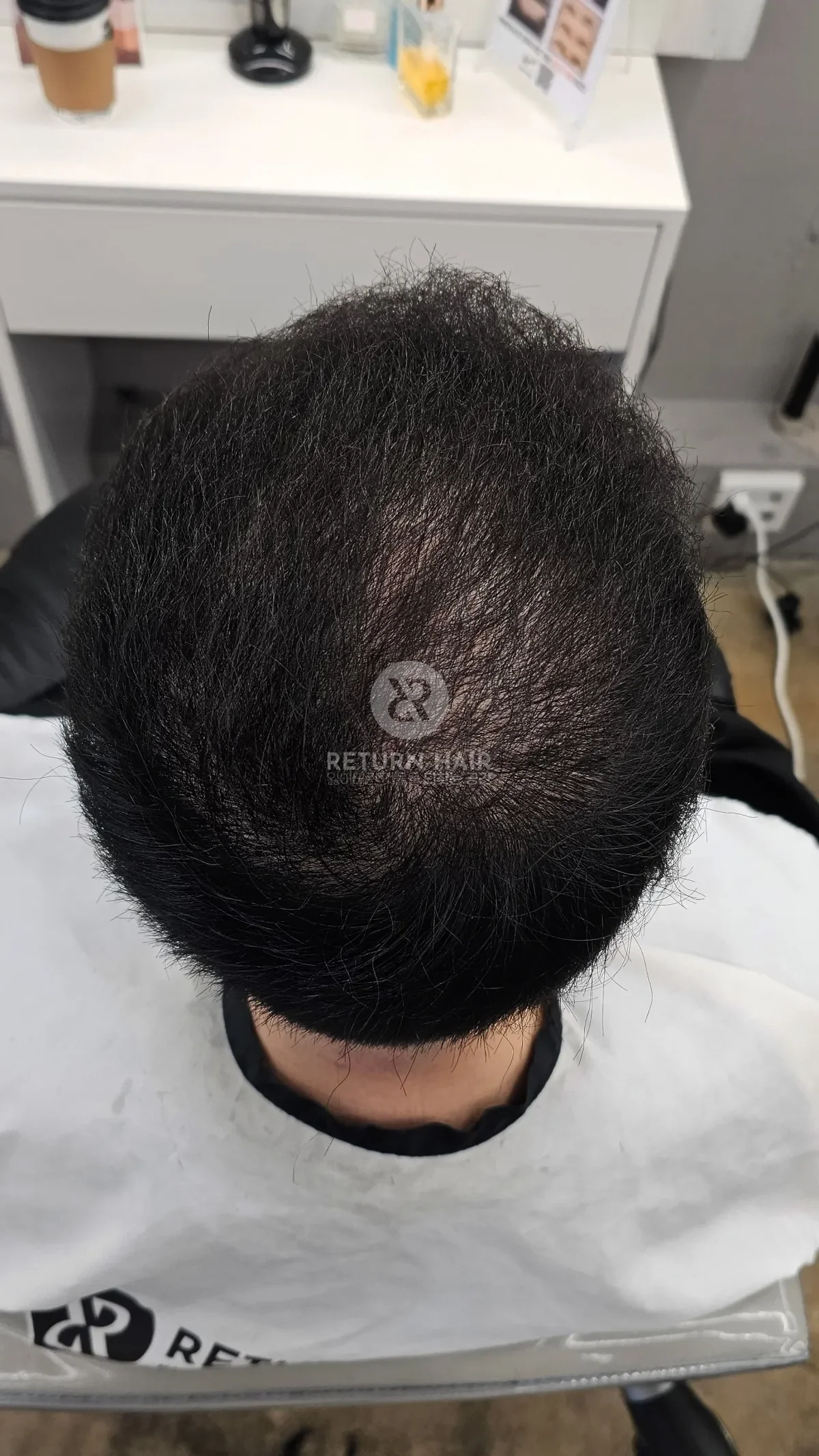 탈모 치트펌 파마 시술 후 결과 사진 6