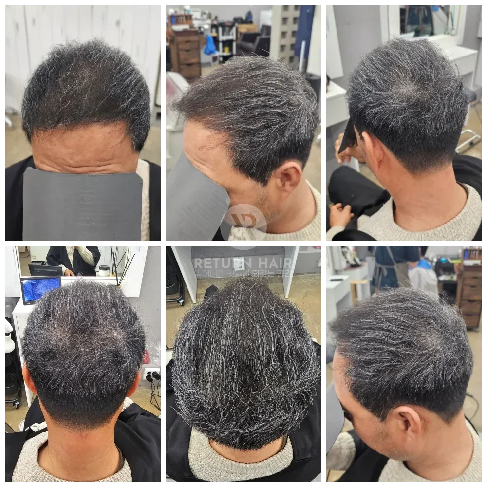 탈모 치트펌 파마 시술 후 결과 사진