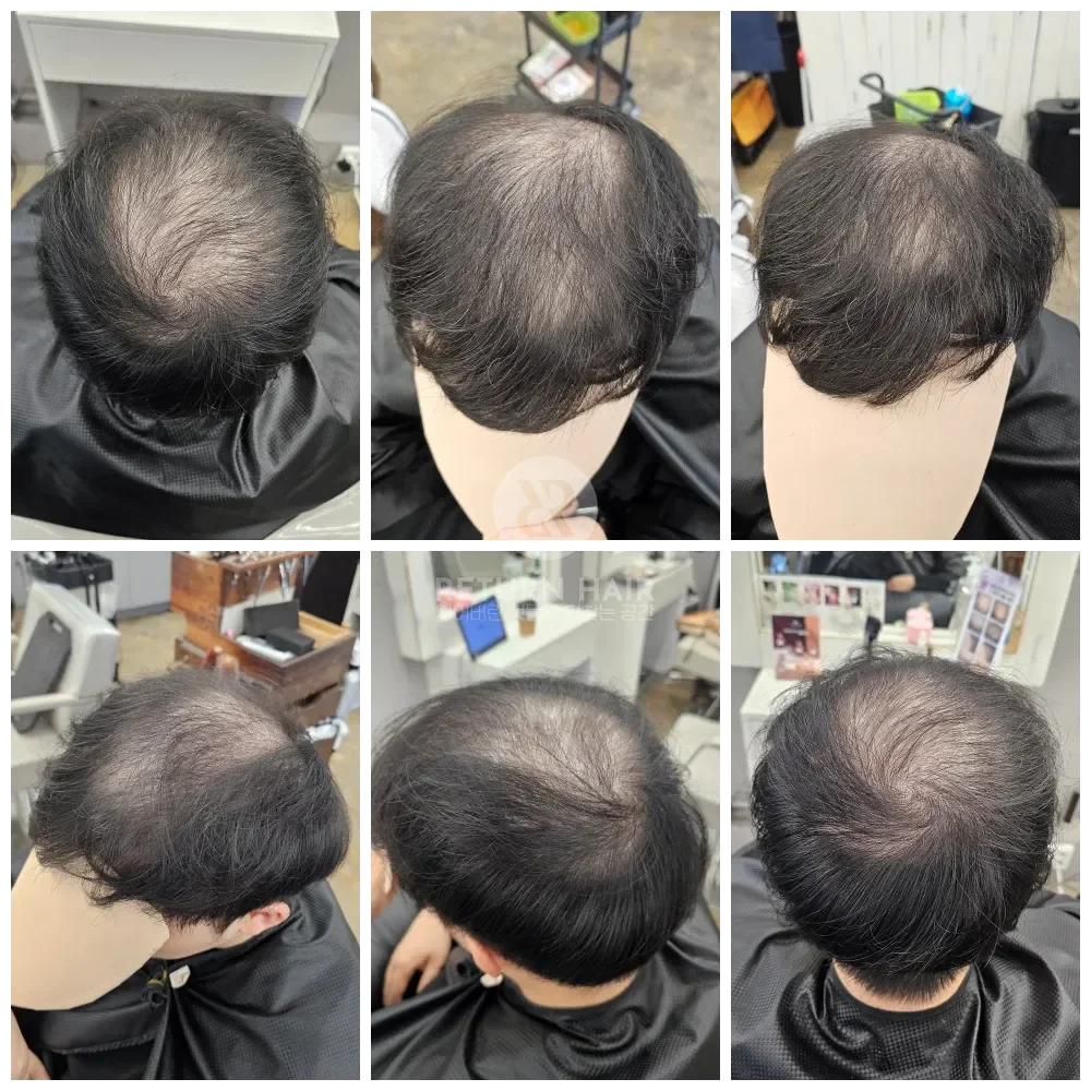 탈모 치트펌 파마 시술 전 사진