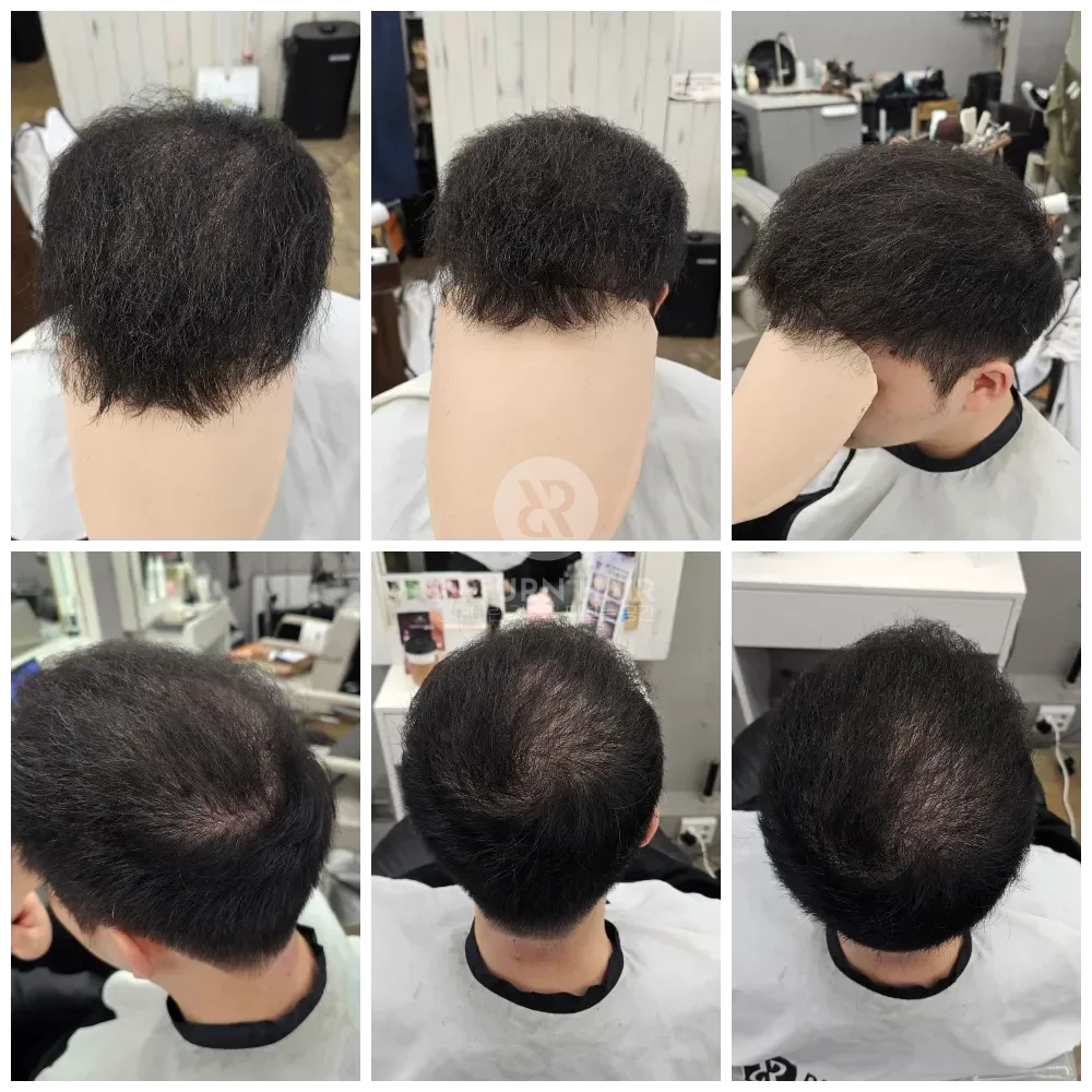 탈모 치트펌 파마 시술 후 결과 사진