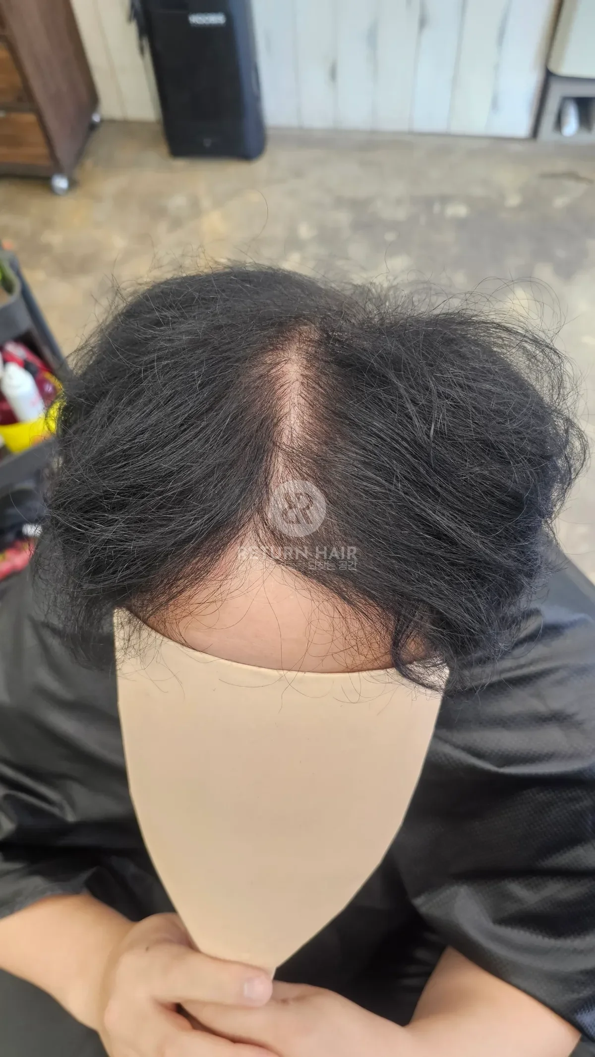 탈모 치트펌 파마 시술 전 사진