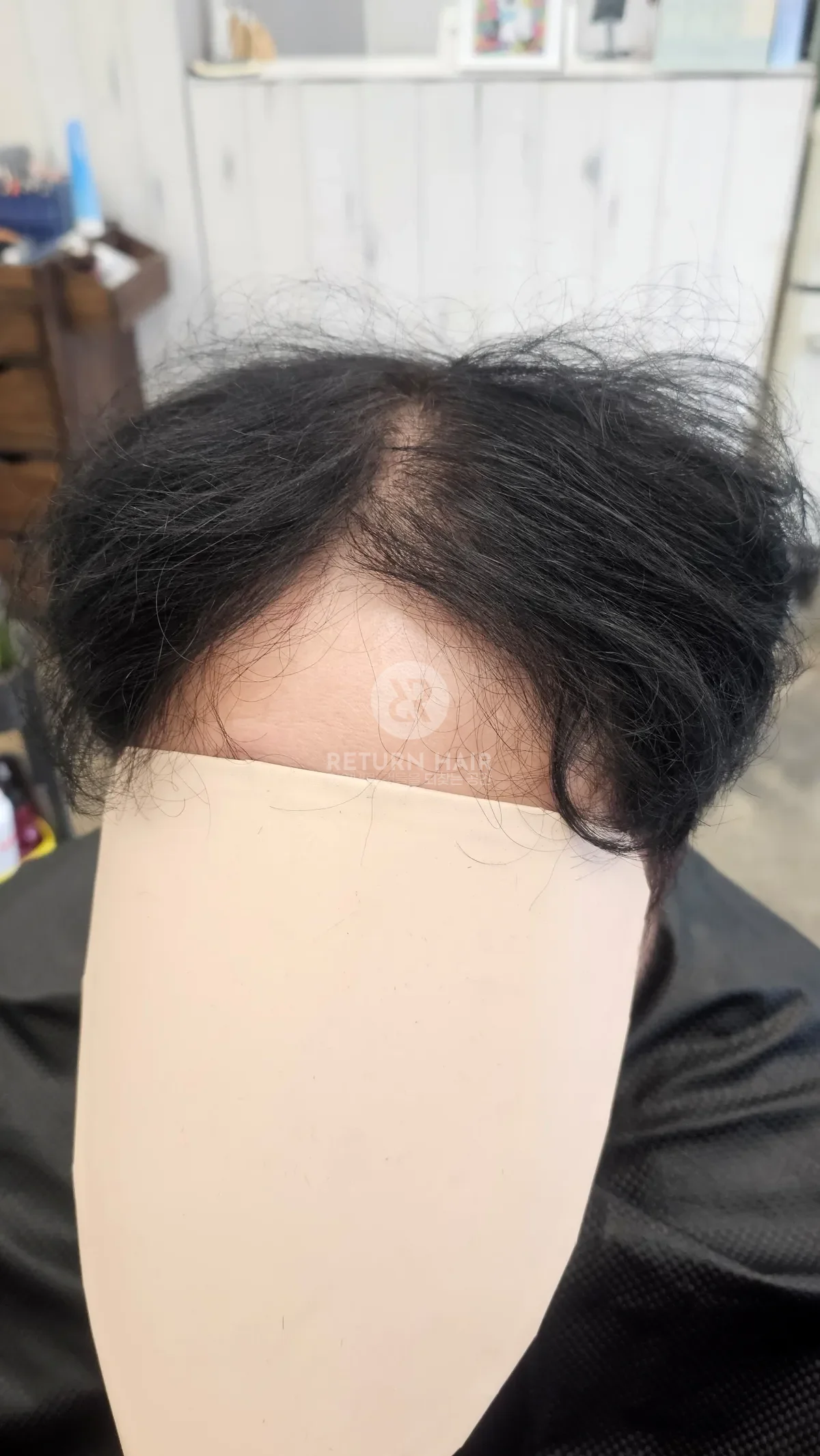 탈모 치트펌 파마 시술 전 사진 2