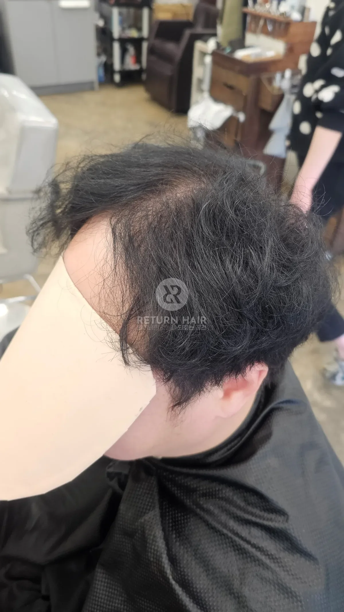 탈모 치트펌 파마 시술 전 사진 3