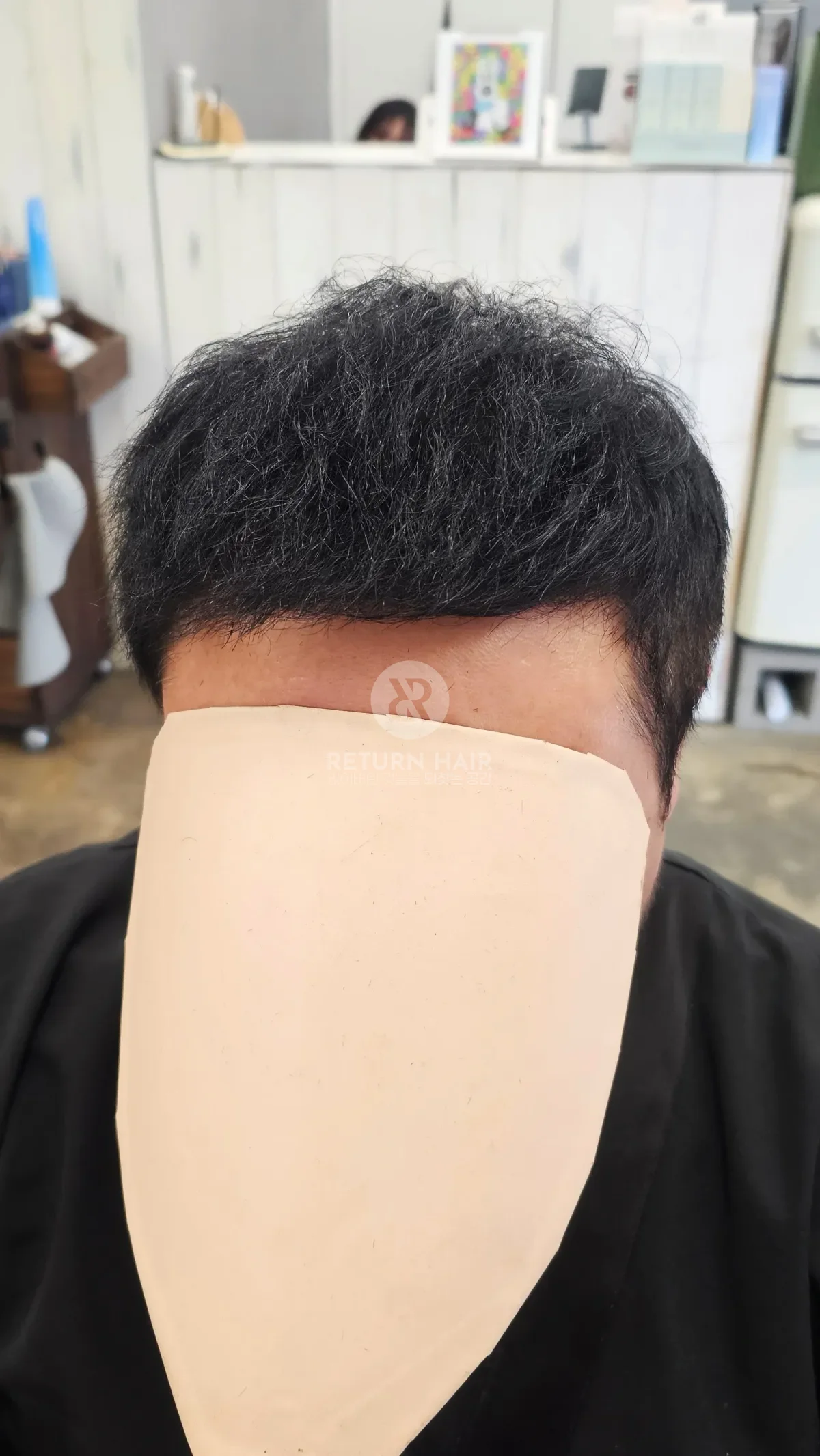 탈모 치트펌 파마 시술 후 결과 사진 2
