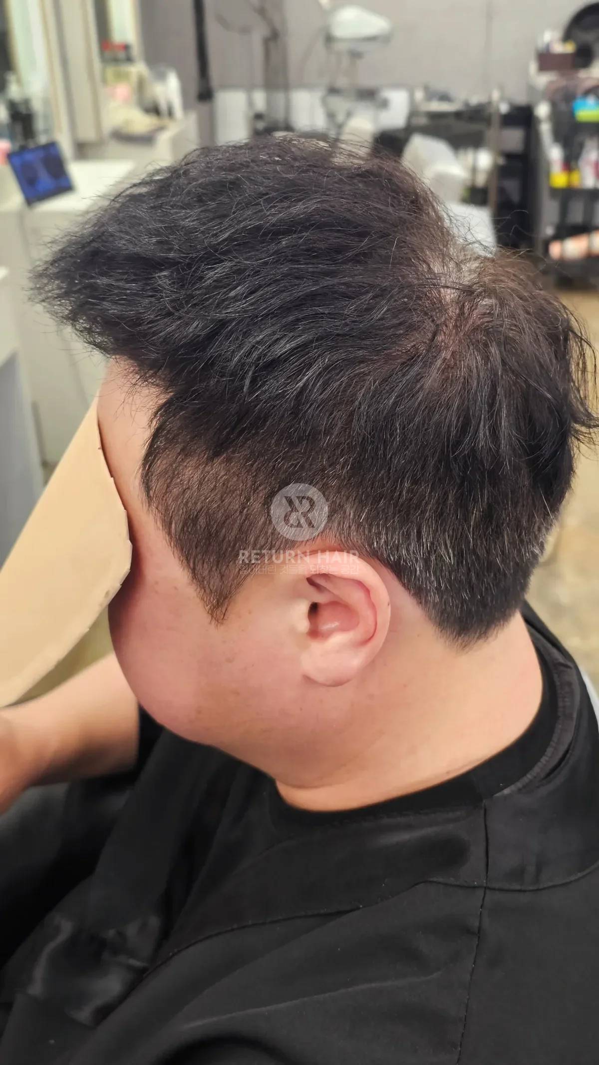 탈모 치트펌 파마 시술 후 결과 사진 4