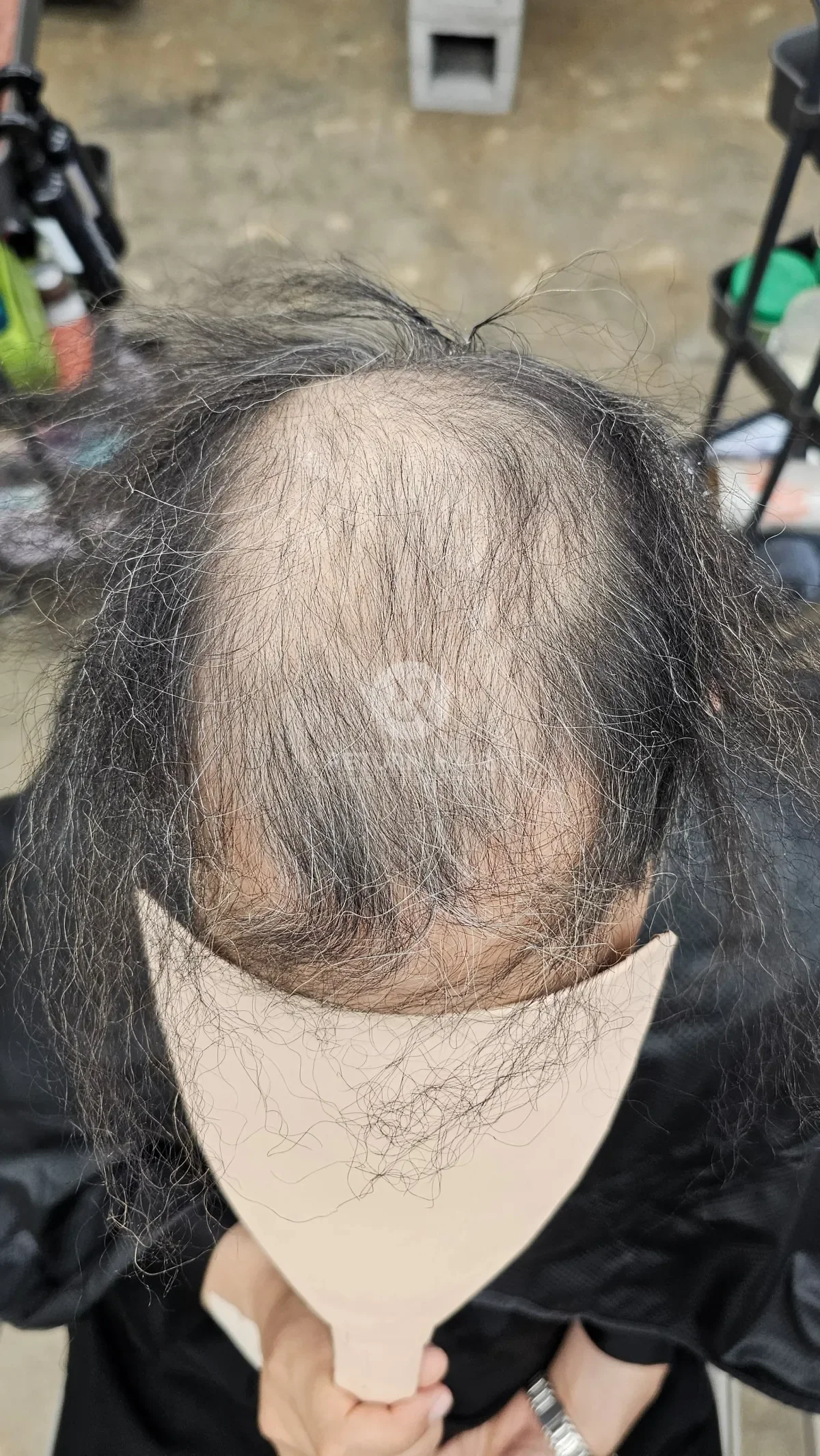 탈모 치트펌 파마 시술 전 사진