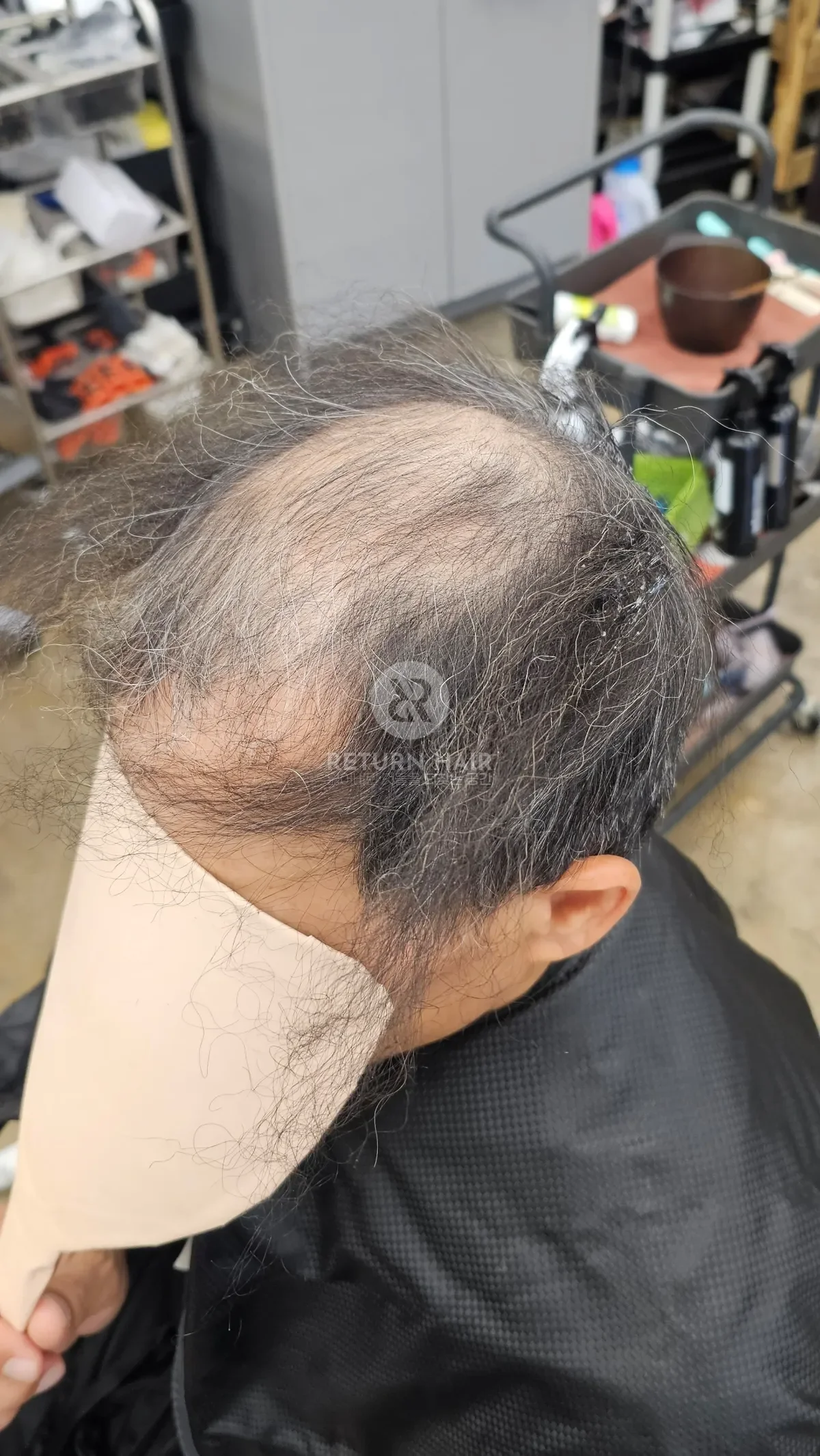 탈모 치트펌 파마 시술 전 사진 3