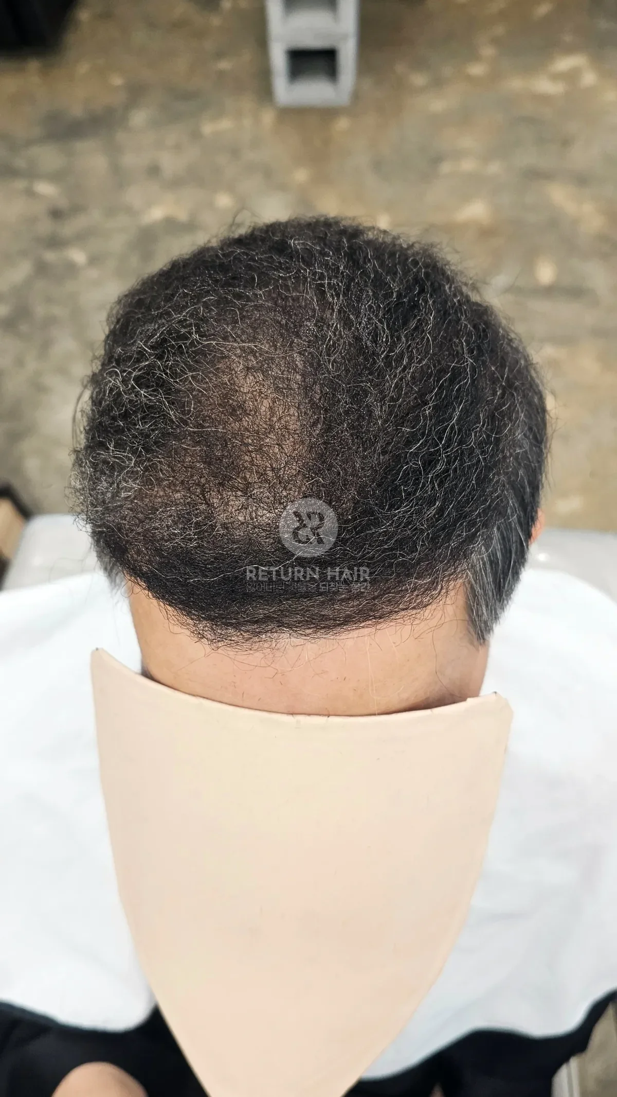 탈모 치트펌 파마 시술 후 결과 사진