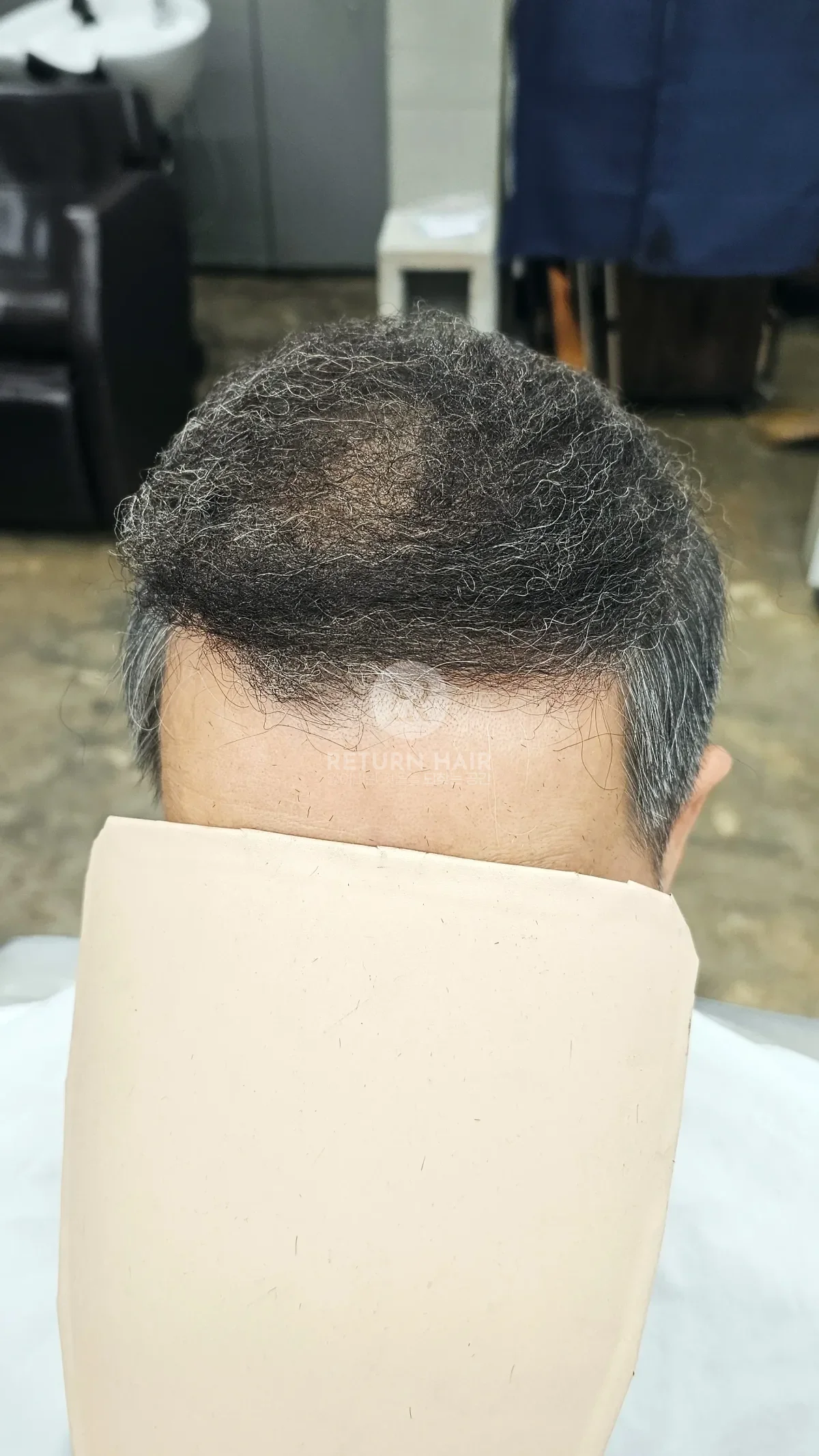 탈모 치트펌 파마 시술 후 결과 사진 2