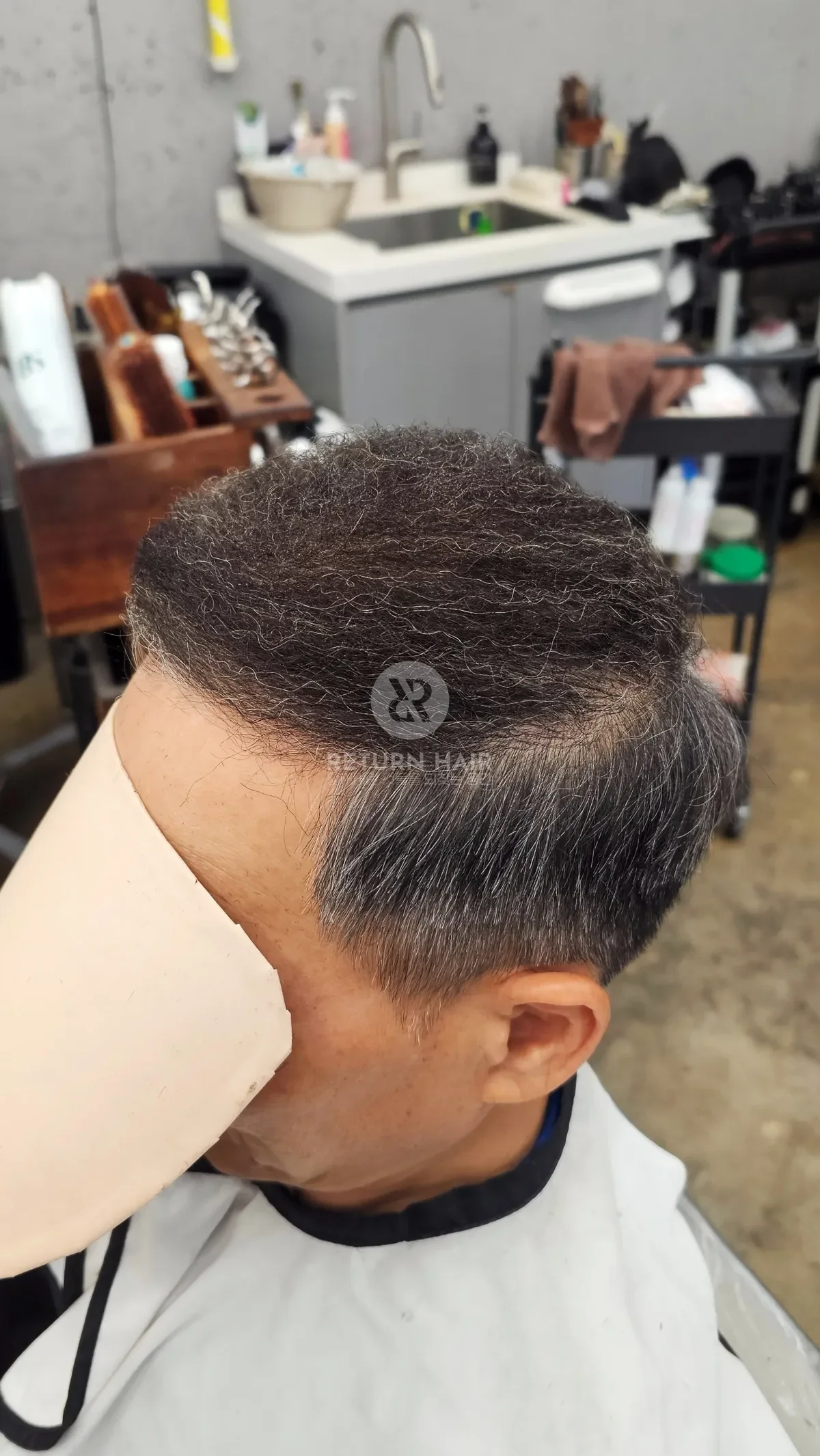 탈모 치트펌 파마 시술 후 결과 사진 3