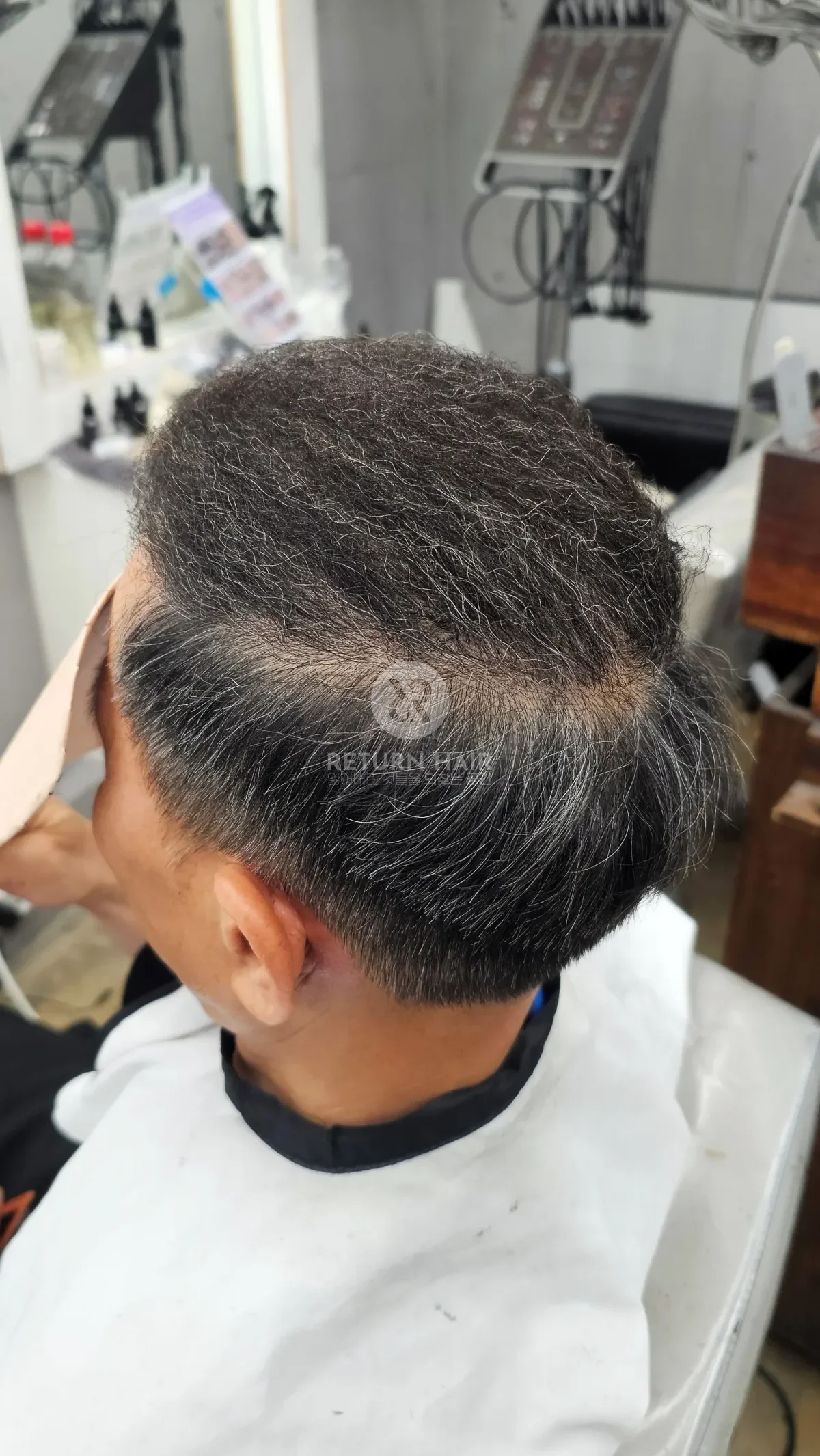 탈모 치트펌 파마 시술 후 결과 사진 4