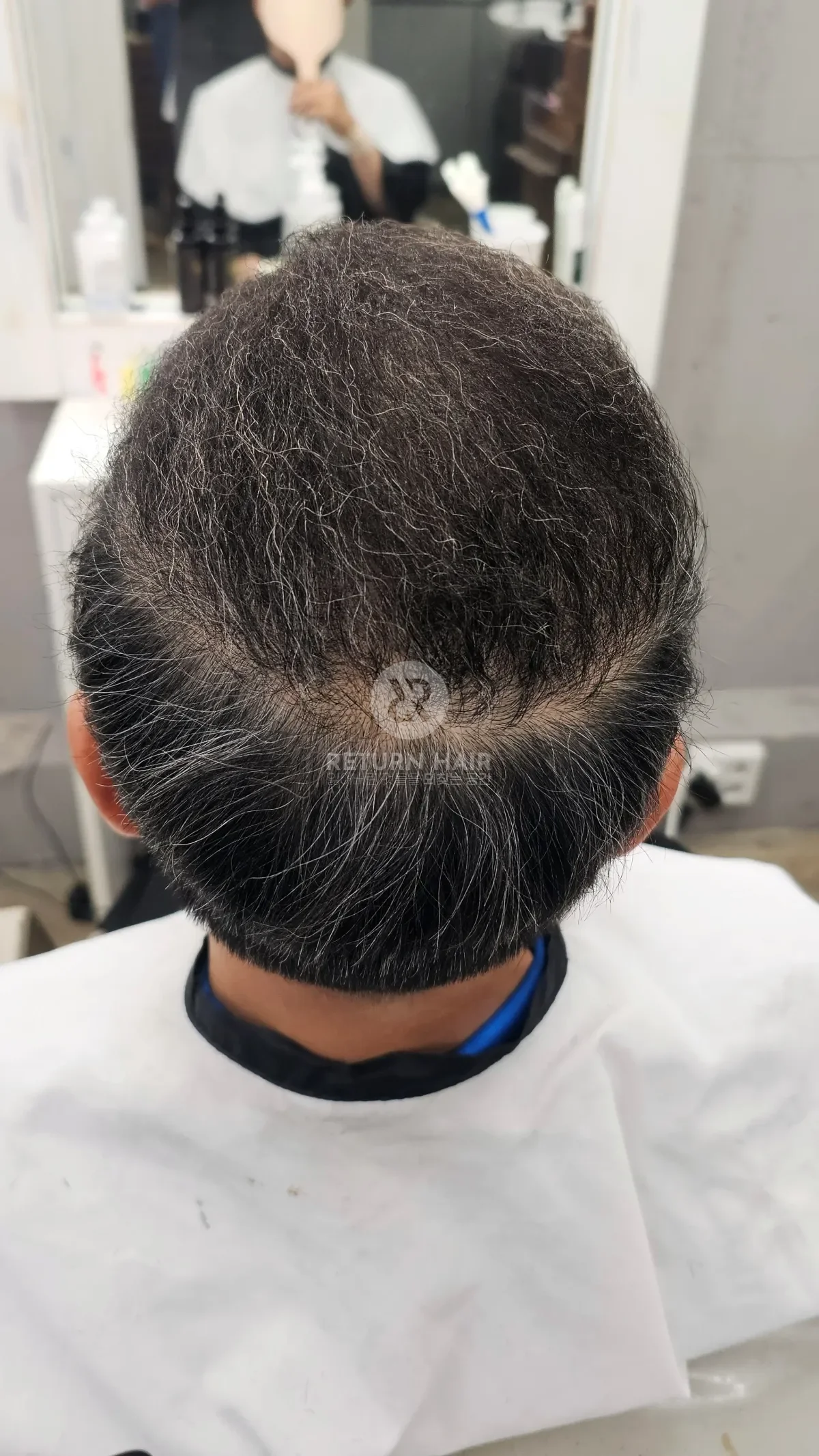 탈모 치트펌 파마 시술 후 결과 사진 5
