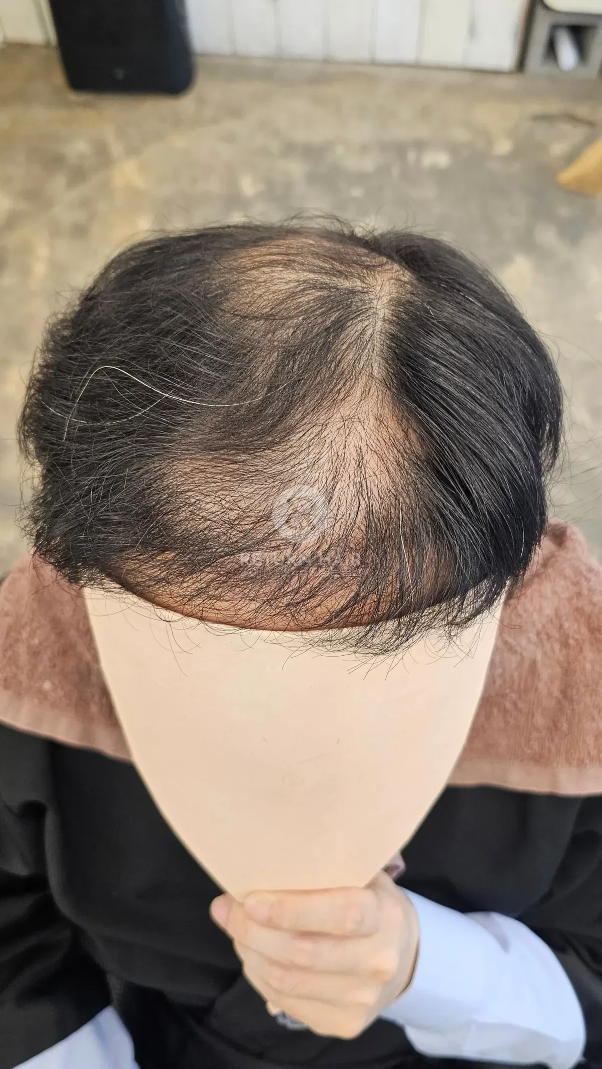탈모 치트펌 파마 시술 전 사진