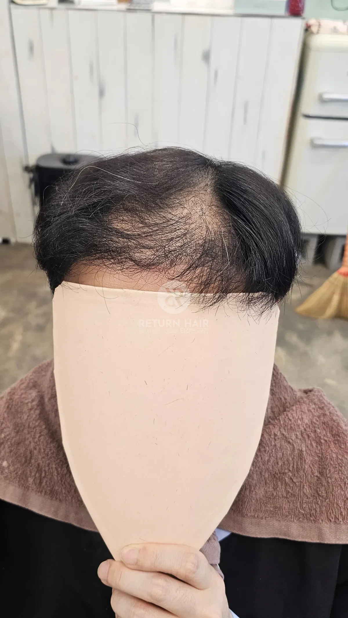 탈모 치트펌 파마 시술 전 사진 2